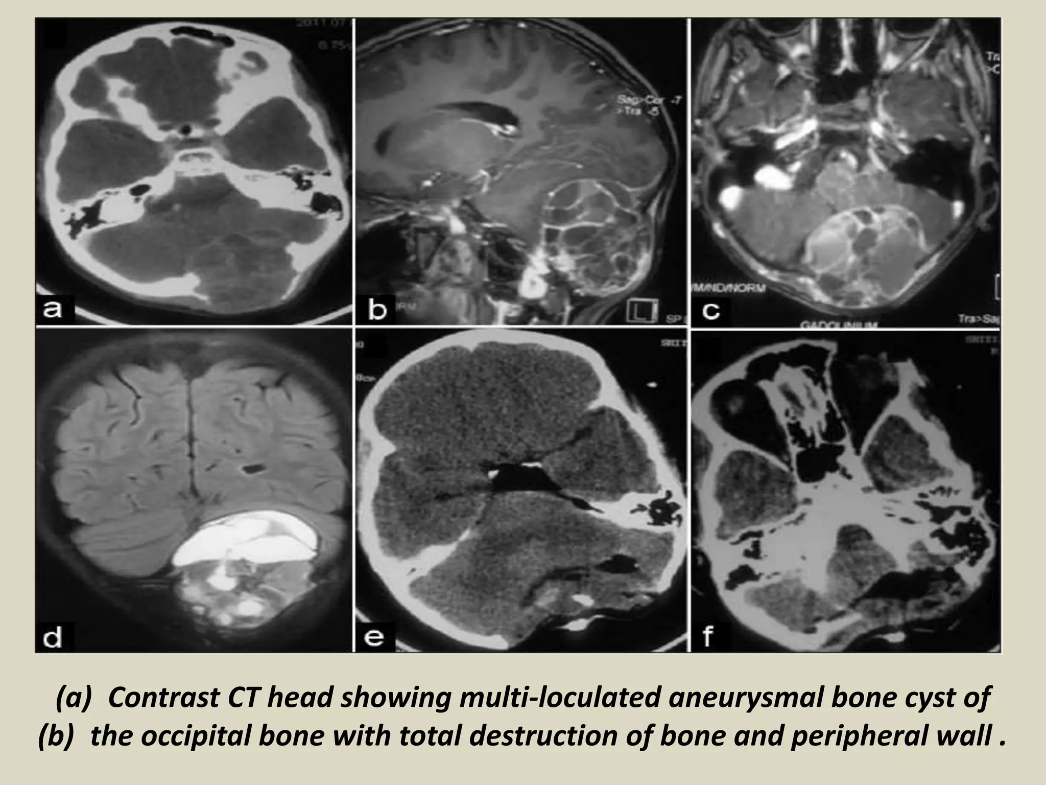 (a) Contrast CT head showing multi-loculated aneurysmal bone cyst of
(b) the occipital bone with total destruction of bone and peripheral wall .
 