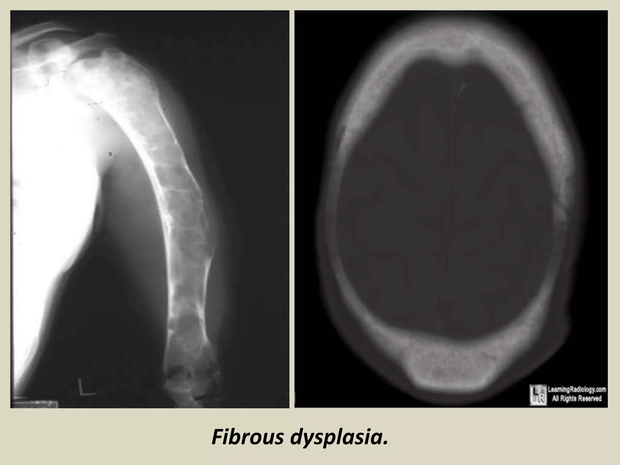 Fibrous dysplasia.
 