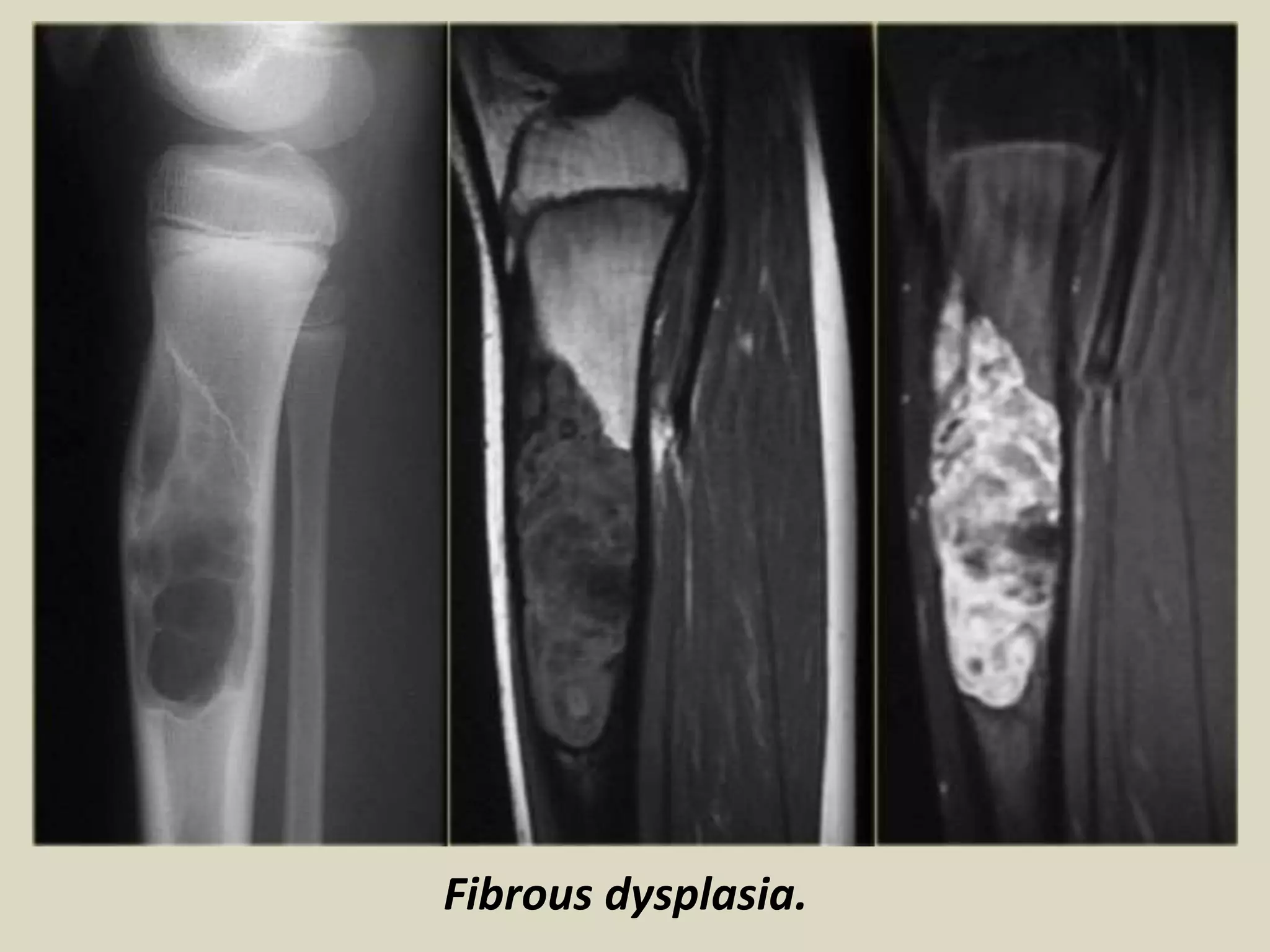 Fibrous dysplasia.
 