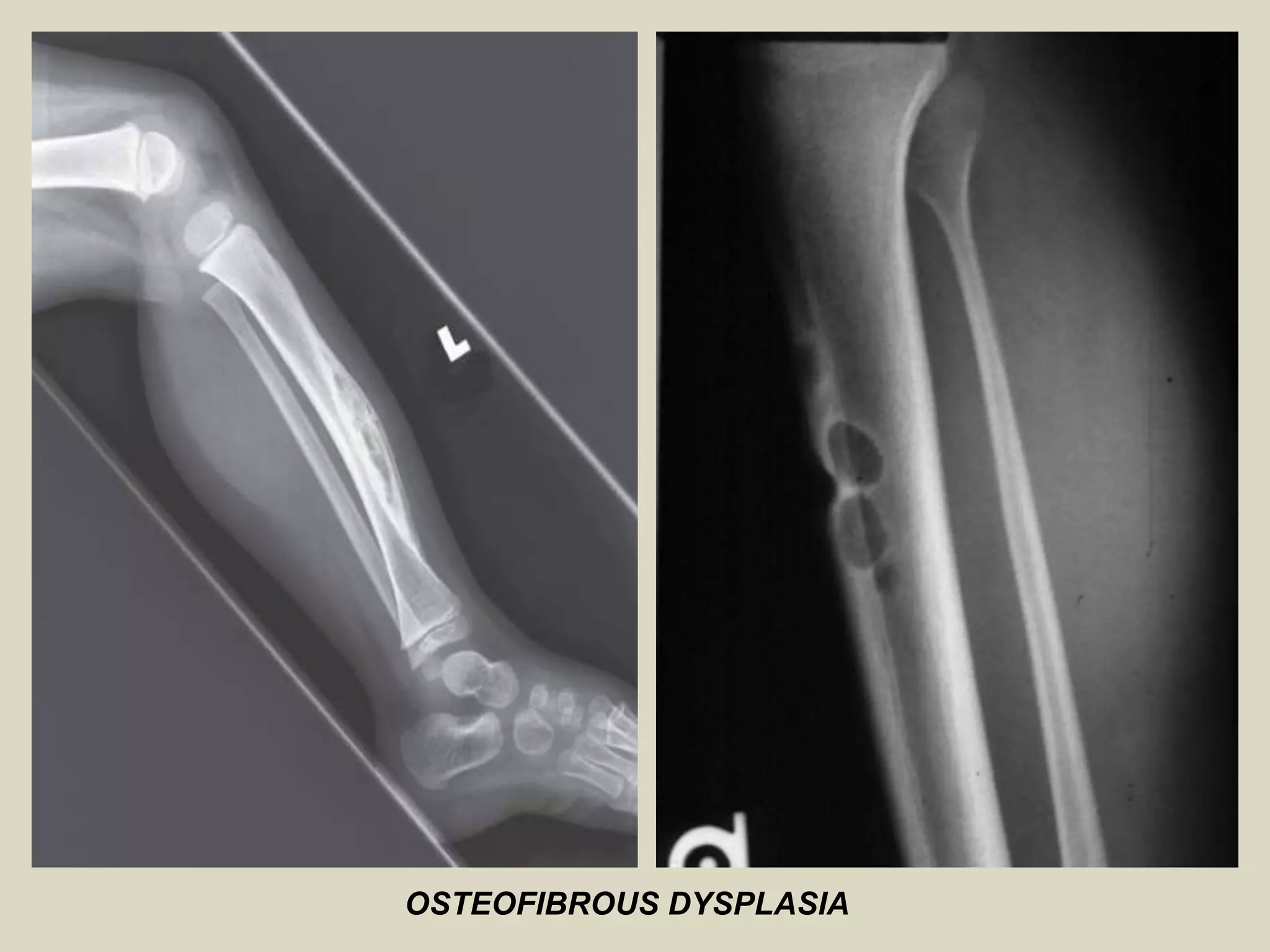 OSTEOFIBROUS DYSPLASIA
 