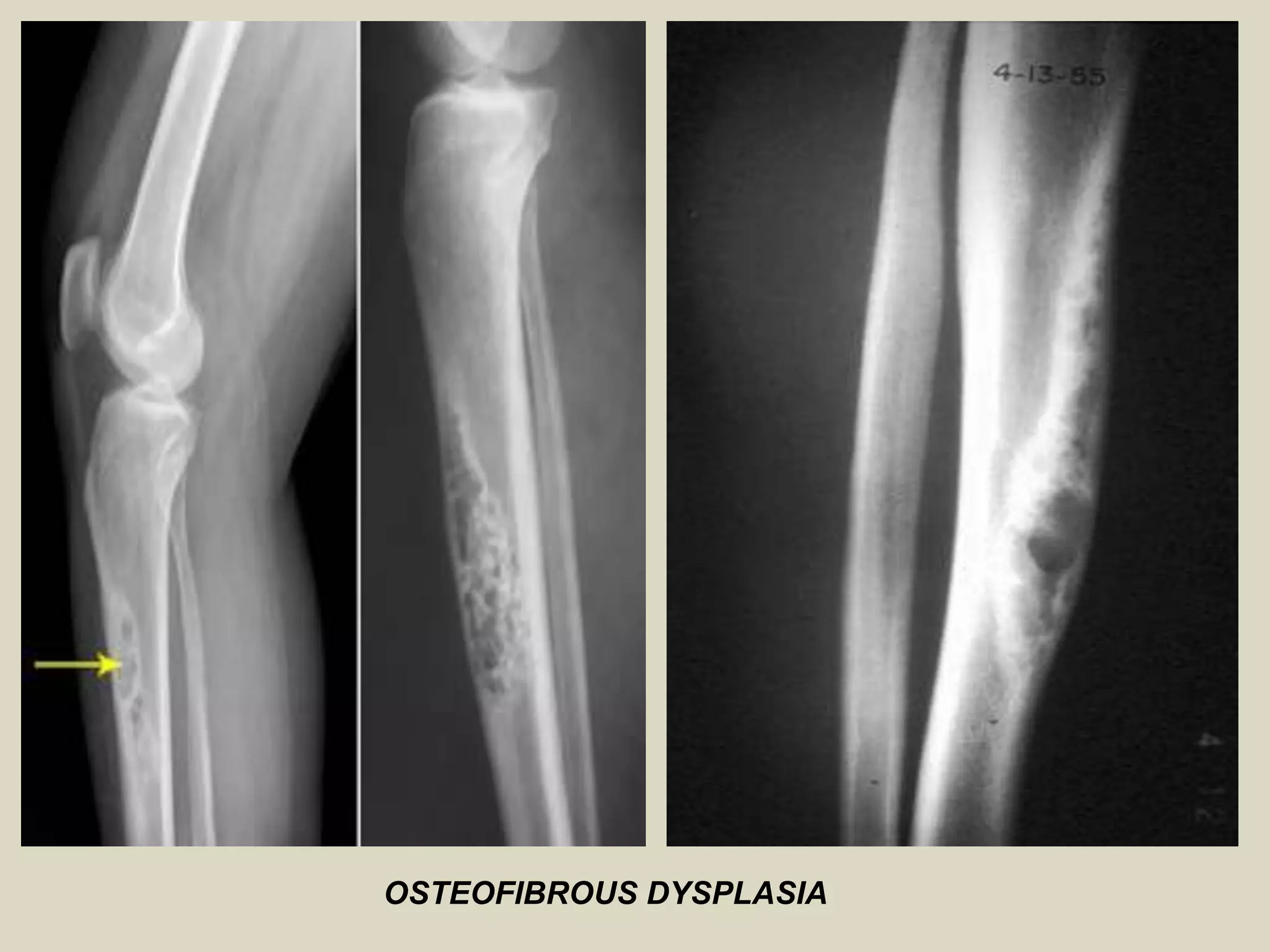 OSTEOFIBROUS DYSPLASIA
 
