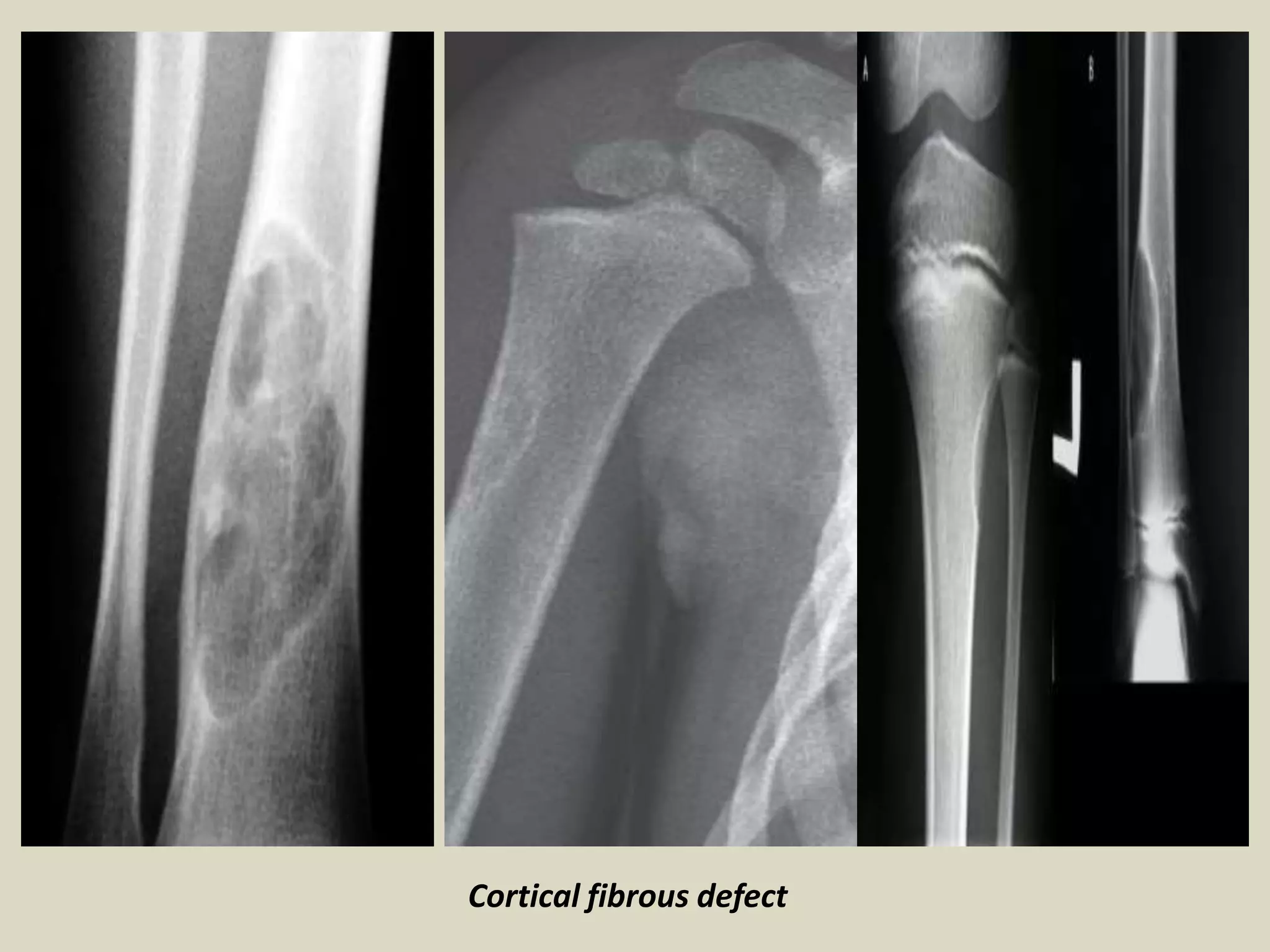 Cortical fibrous defect
 