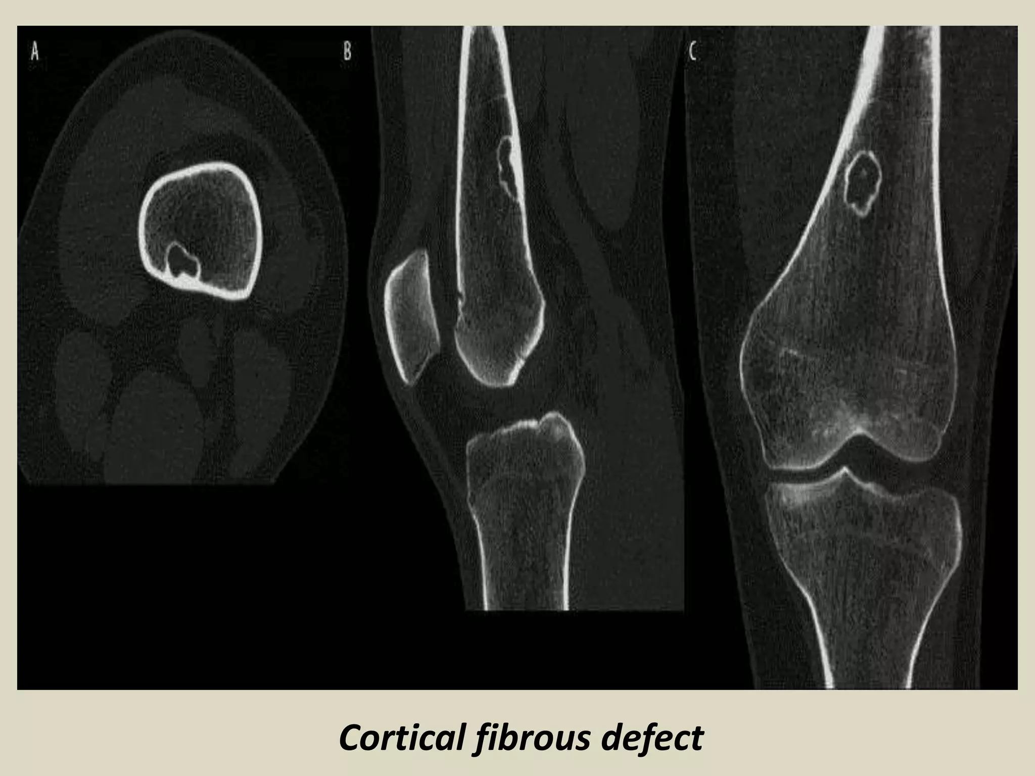 Cortical fibrous defect
 