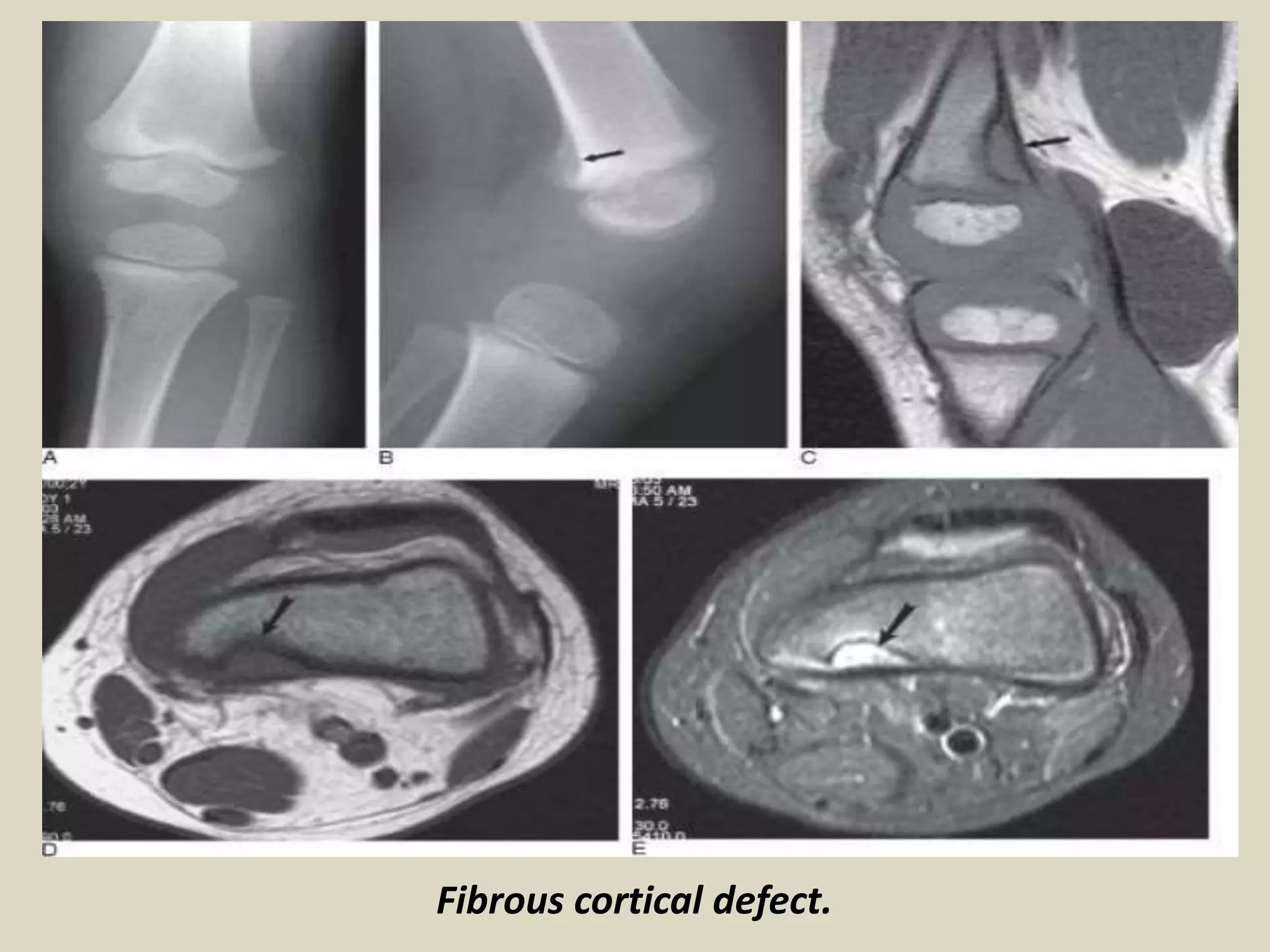 Fibrous cortical defect.
 