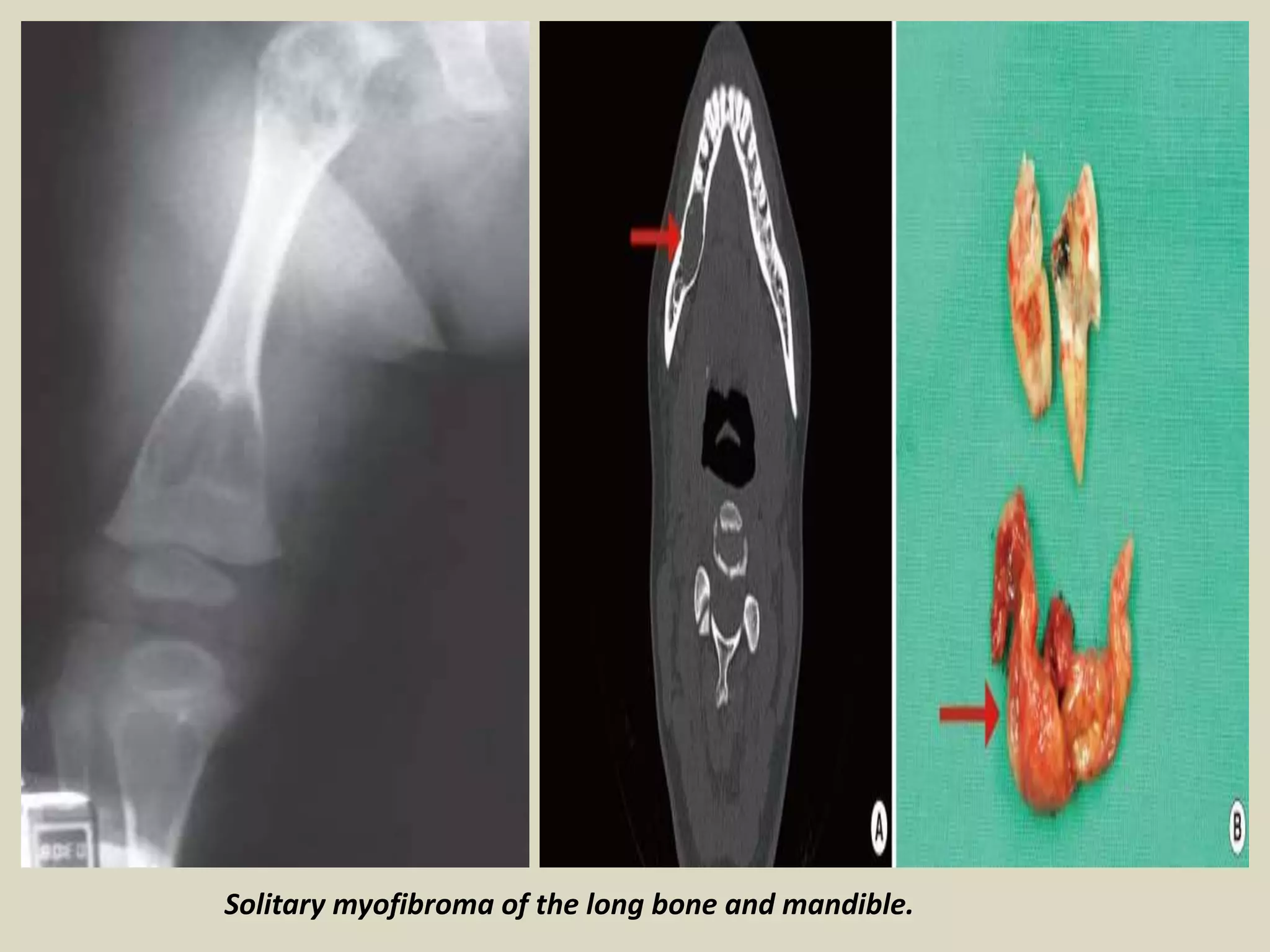 Solitary myofibroma of the long bone and mandible.
 