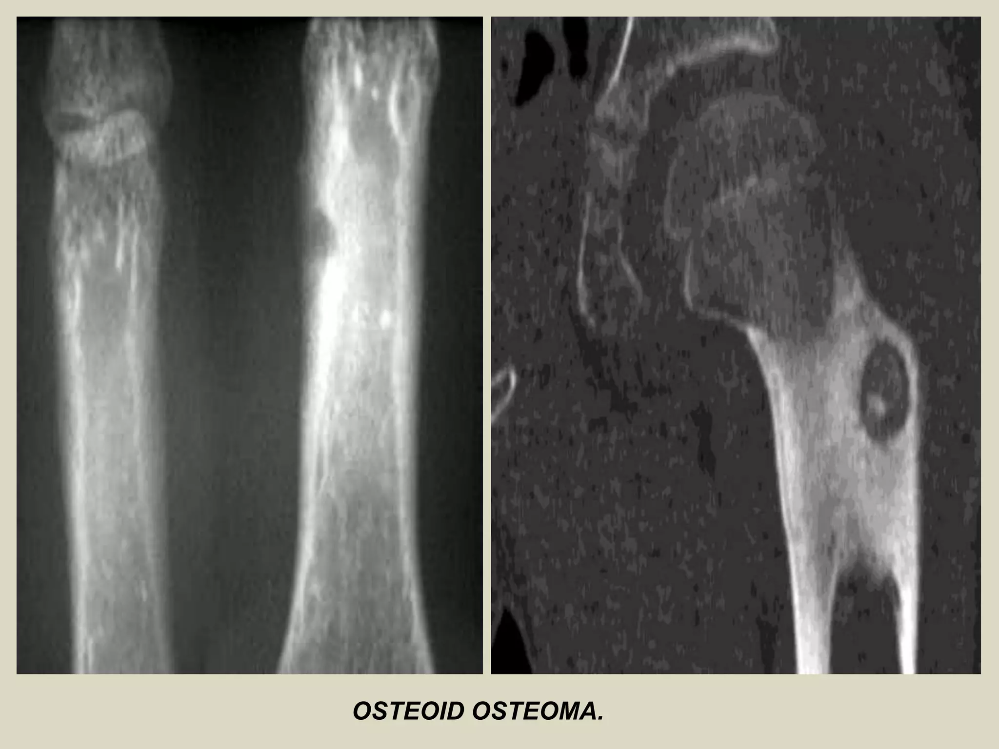 OSTEOID OSTEOMA.
 