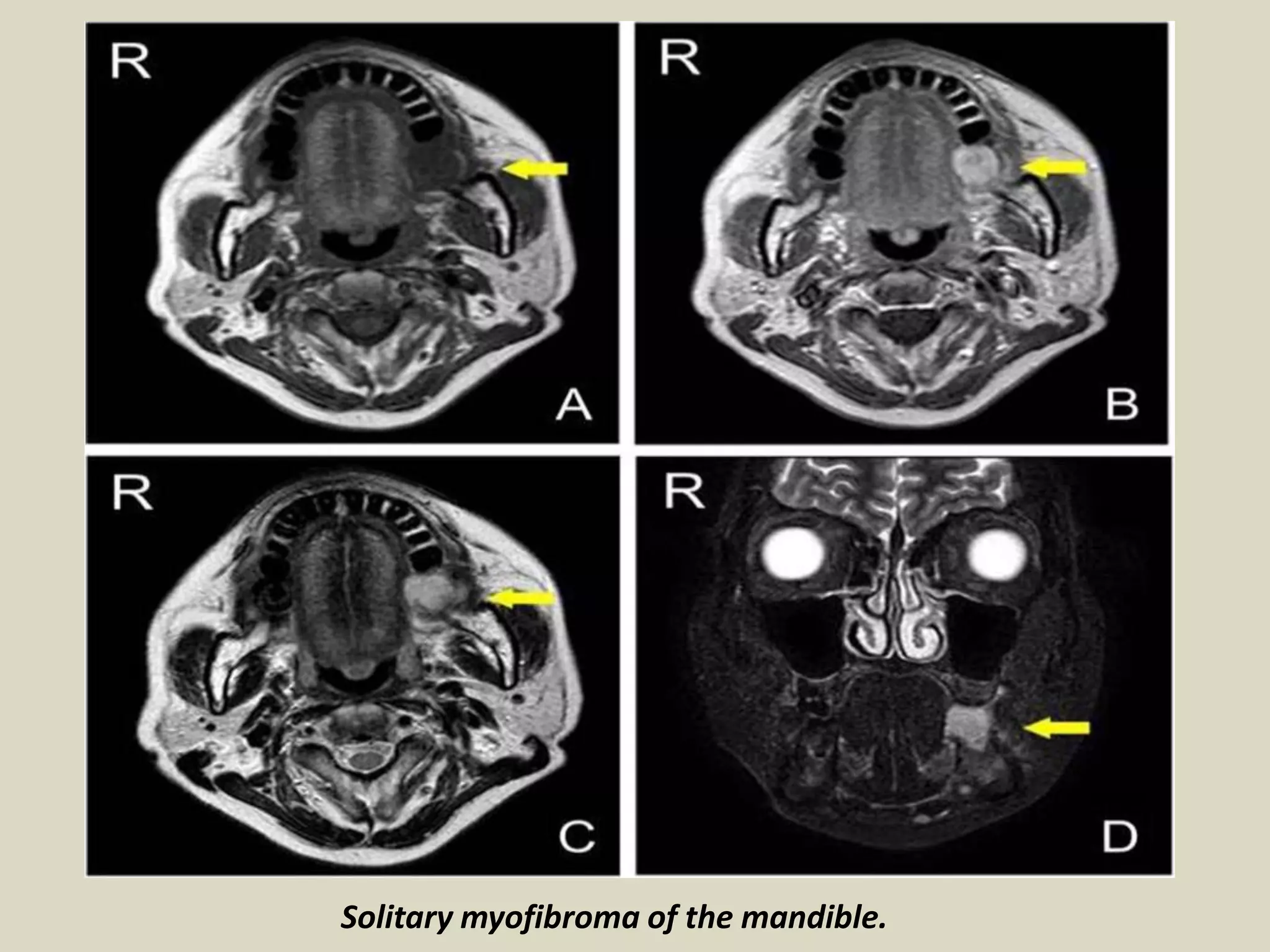 Solitary myofibroma of the mandible.
 