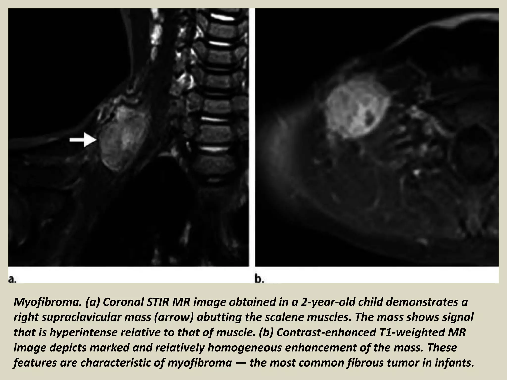 Myofibroma. (a) Coronal STIR MR image obtained in a 2-year-old child demonstrates a
right supraclavicular mass (arrow) abutting the scalene muscles. The mass shows signal
that is hyperintense relative to that of muscle. (b) Contrast-enhanced T1-weighted MR
image depicts marked and relatively homogeneous enhancement of the mass. These
features are characteristic of myofibroma — the most common fibrous tumor in infants.
 