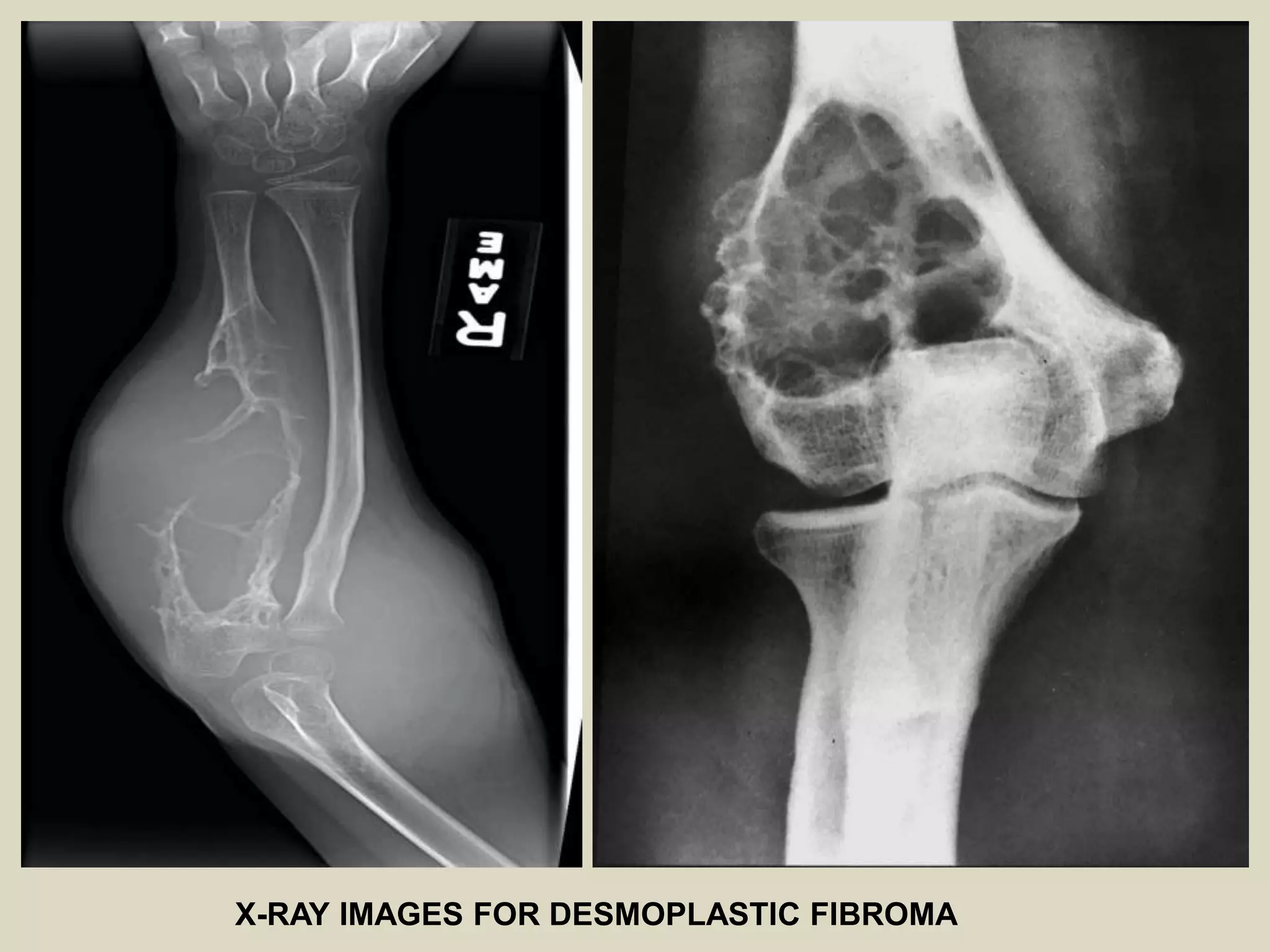 X-RAY IMAGES FOR DESMOPLASTIC FIBROMA
 