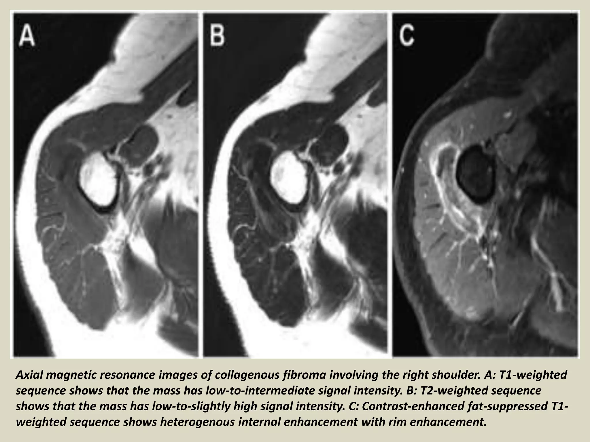 Axial magnetic resonance images of collagenous fibroma involving the right shoulder. A: T1-weighted
sequence shows that the mass has low-to-intermediate signal intensity. B: T2-weighted sequence
shows that the mass has low-to-slightly high signal intensity. C: Contrast-enhanced fat-suppressed T1-
weighted sequence shows heterogenous internal enhancement with rim enhancement.
 