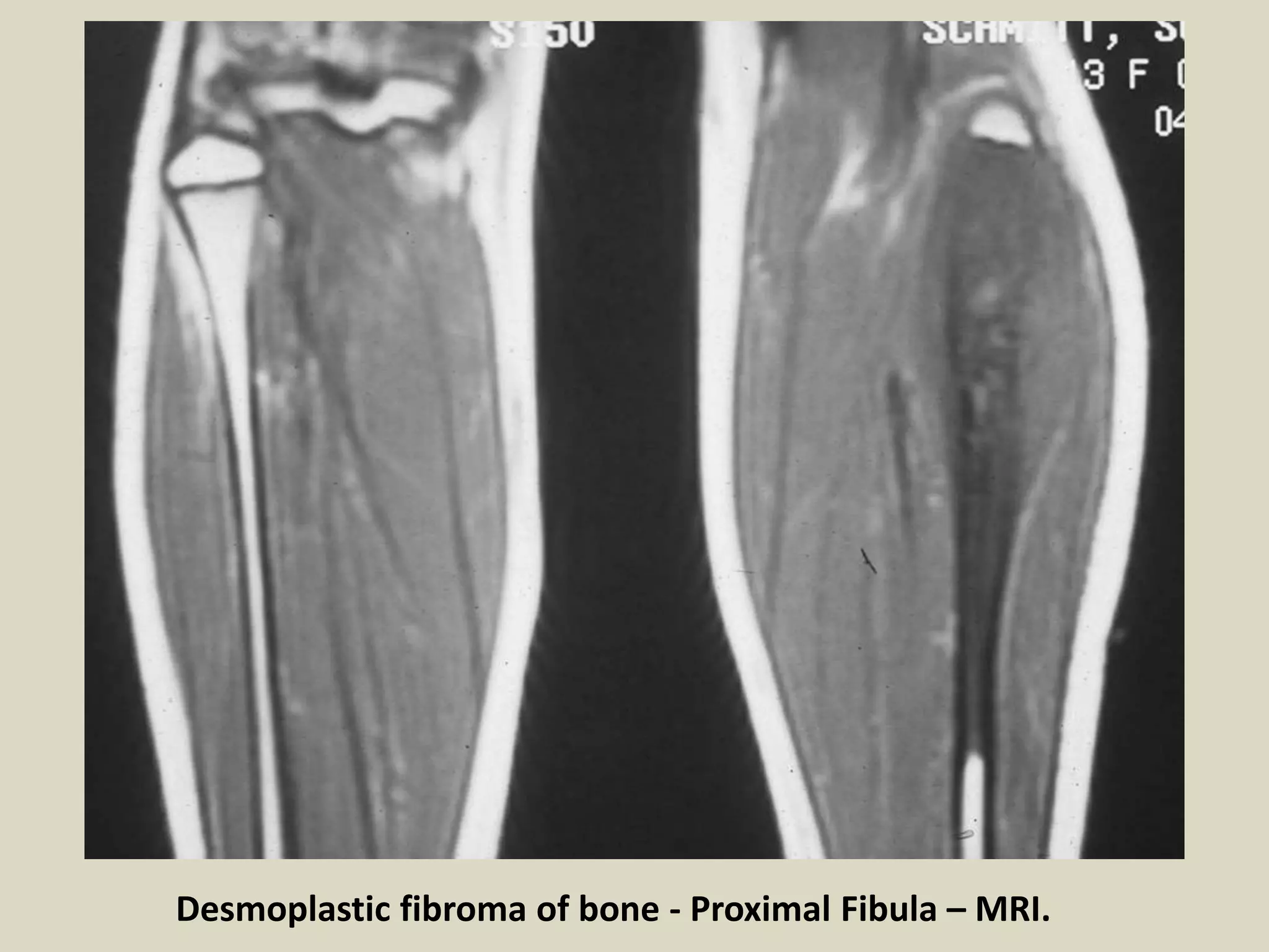 Desmoplastic fibroma of bone - Proximal Fibula – MRI.
 