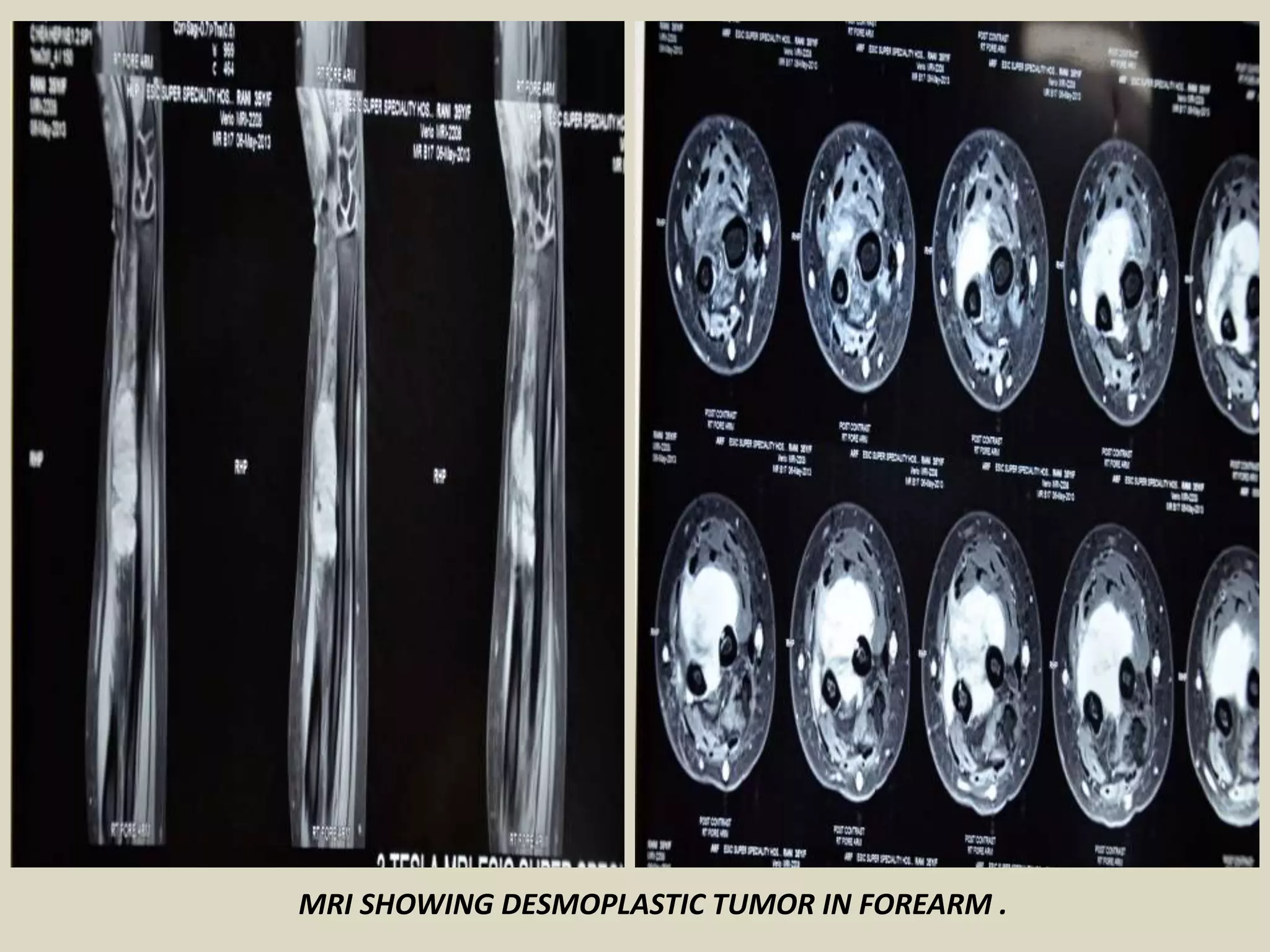MRI SHOWING DESMOPLASTIC TUMOR IN FOREARM ​.
 
