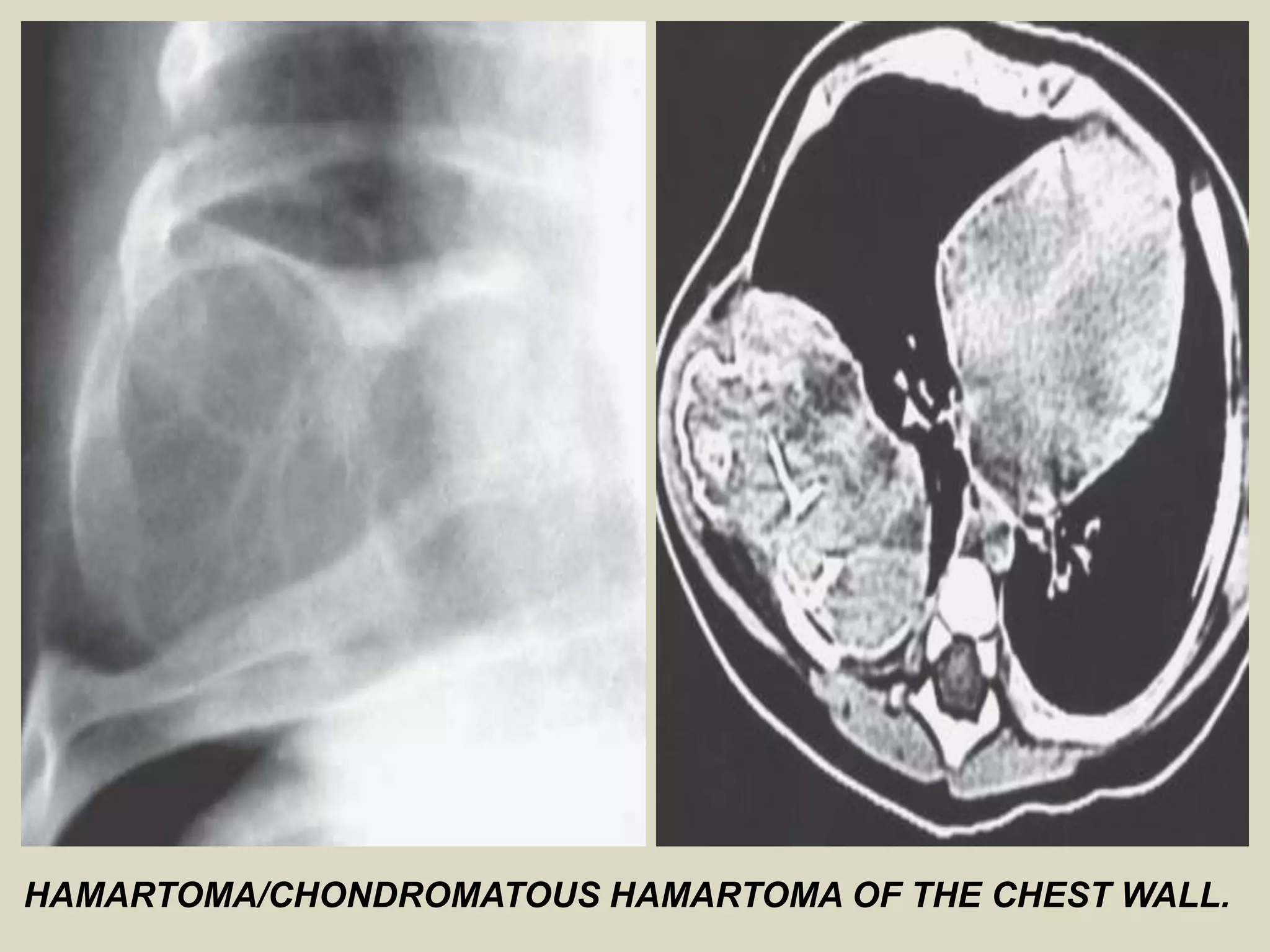 HAMARTOMA/CHONDROMATOUS HAMARTOMA OF THE CHEST WALL.
 