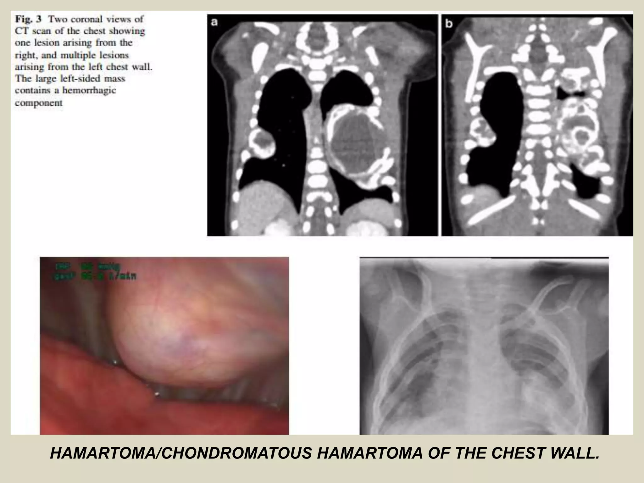 HAMARTOMA/CHONDROMATOUS HAMARTOMA OF THE CHEST WALL.
 