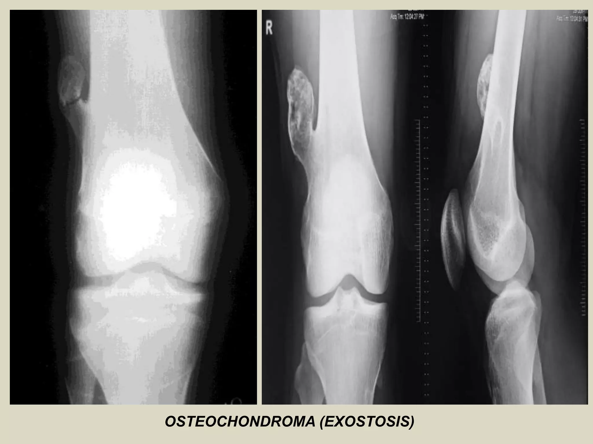 OSTEOCHONDROMA (EXOSTOSIS)
 