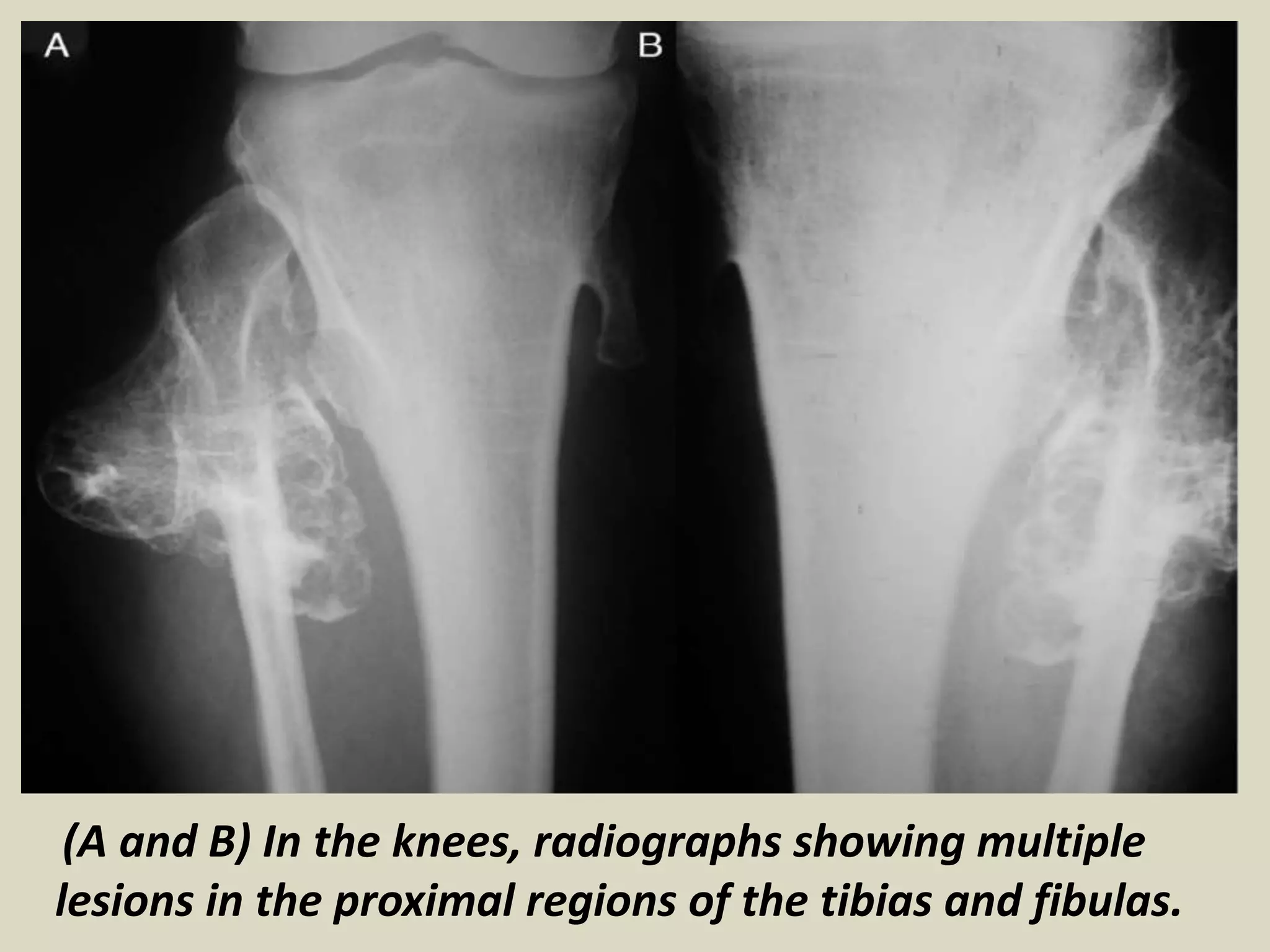 (A and B) In the knees, radiographs showing multiple
lesions in the proximal regions of the tibias and fibulas.
 