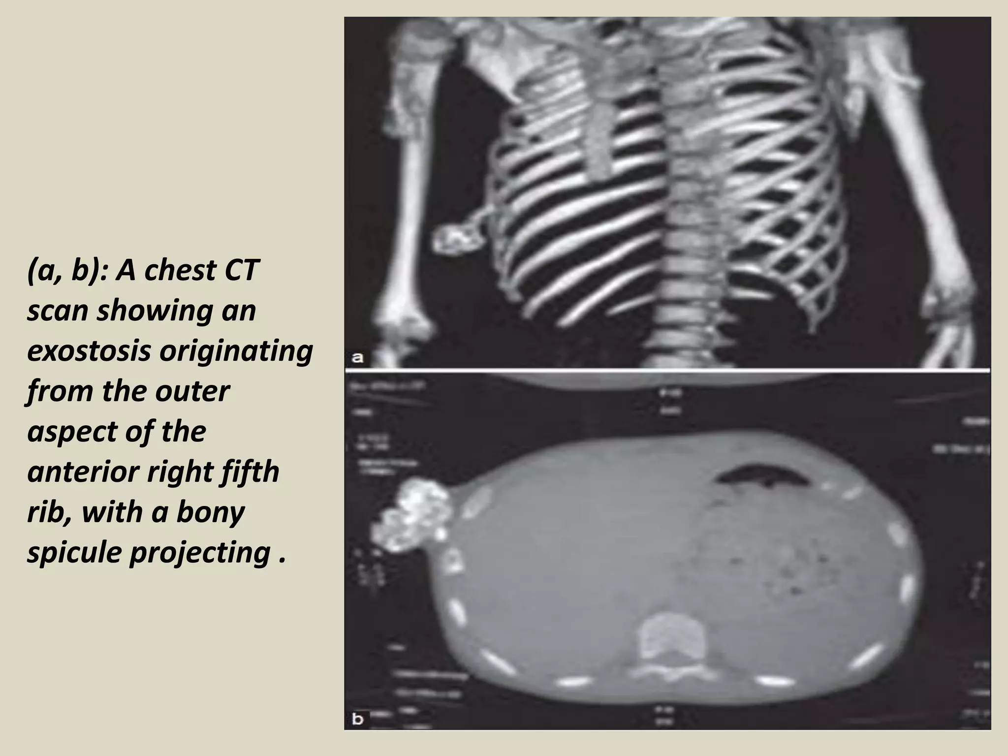 (a, b): A chest CT
scan showing an
exostosis originating
from the outer
aspect of the
anterior right fifth
rib, with a bony
spicule projecting .
 
