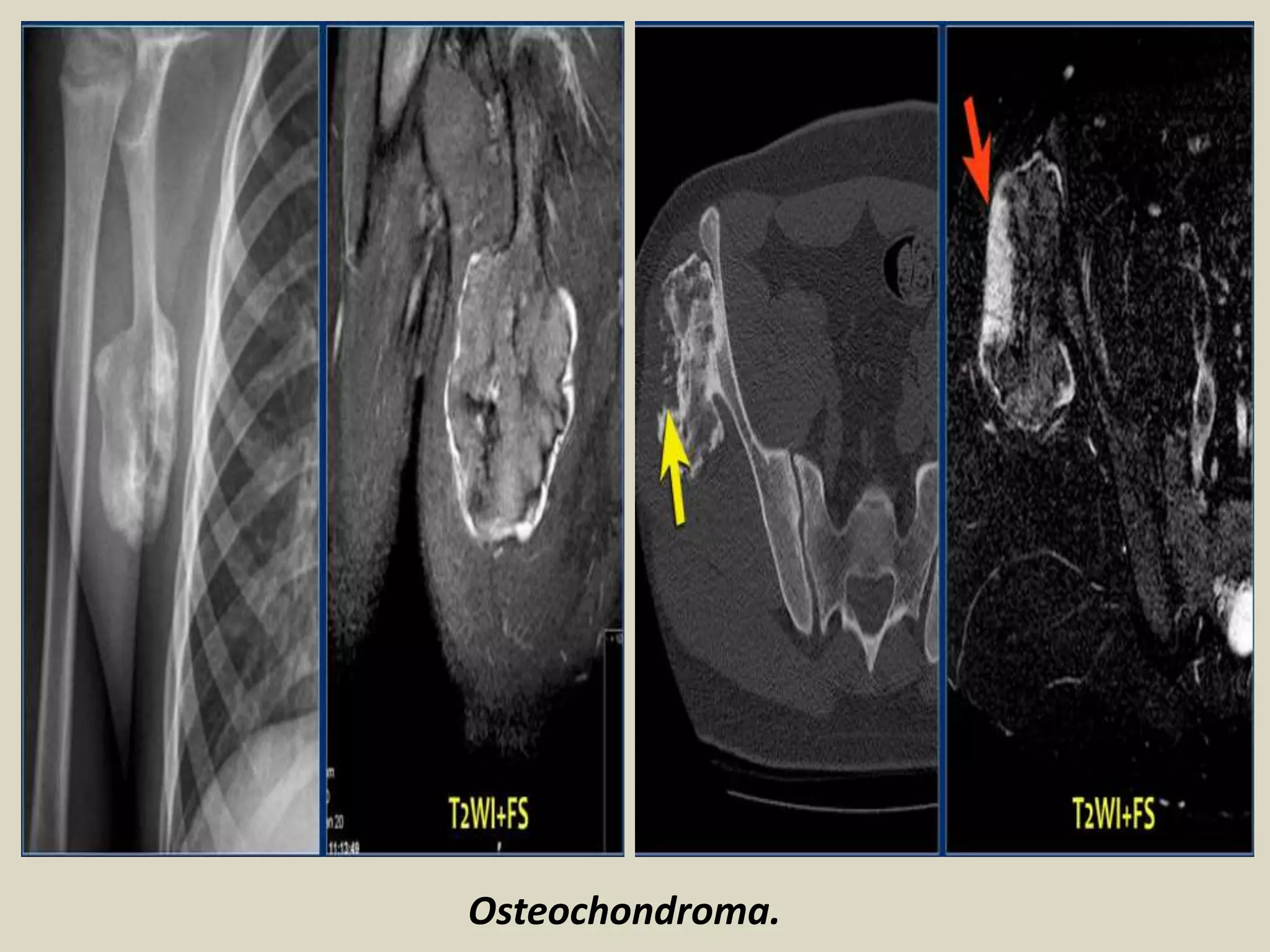 Osteochondroma.
 