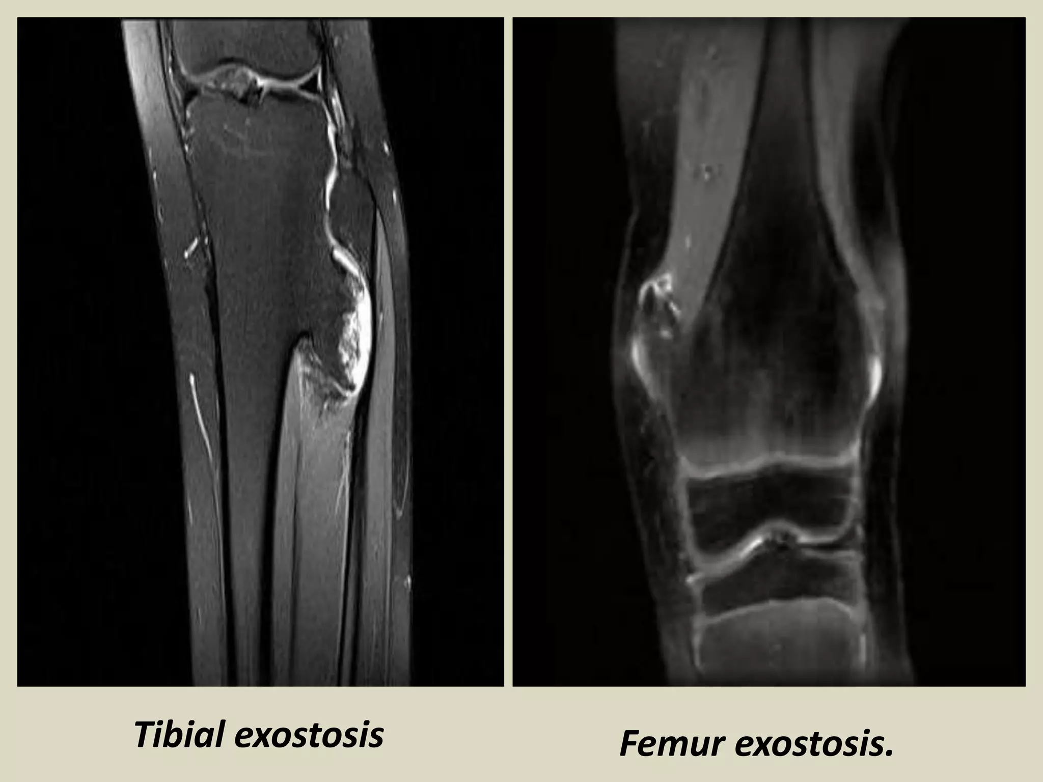 Tibial exostosis Femur exostosis.
 