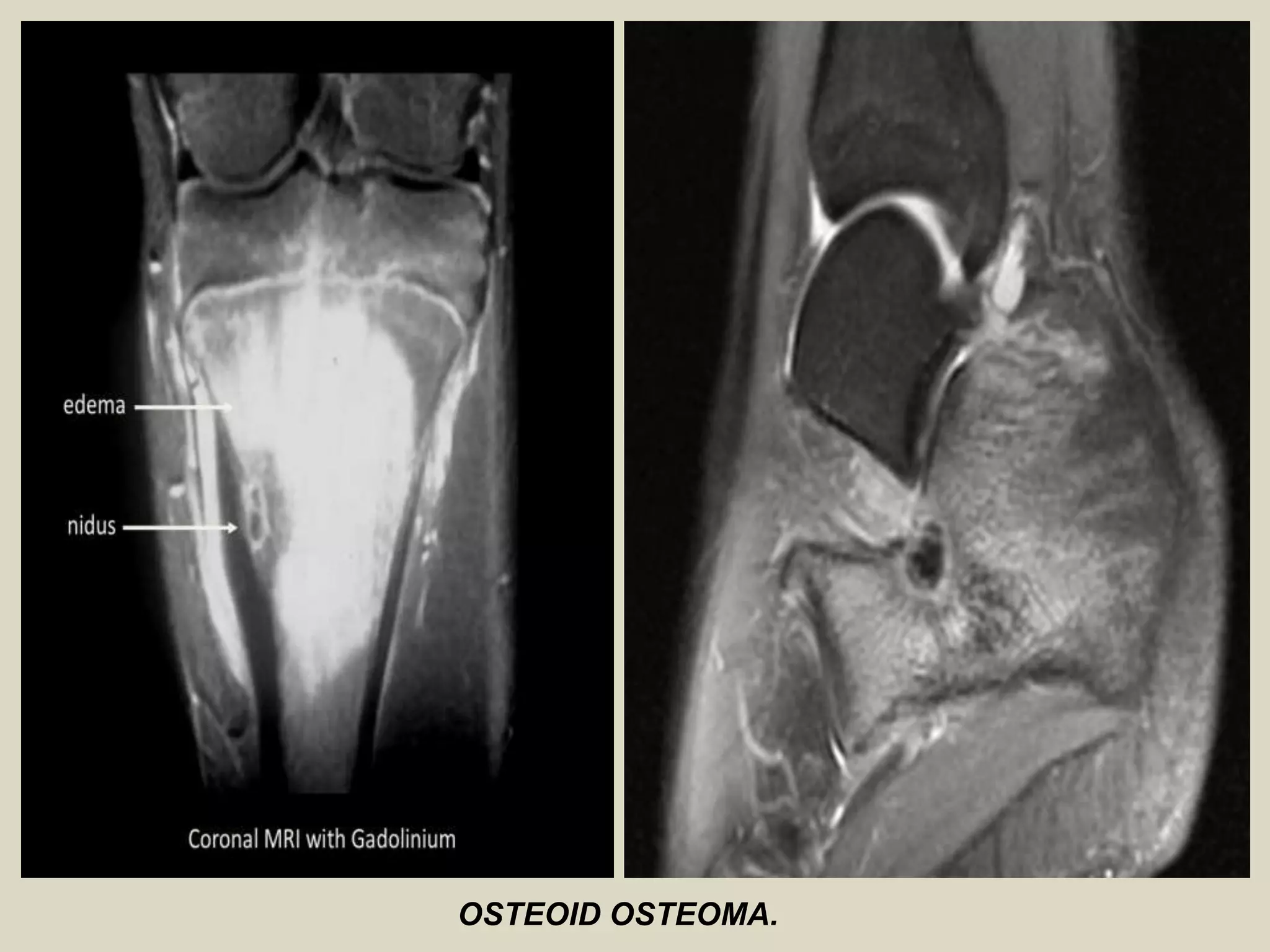 OSTEOID OSTEOMA.
 