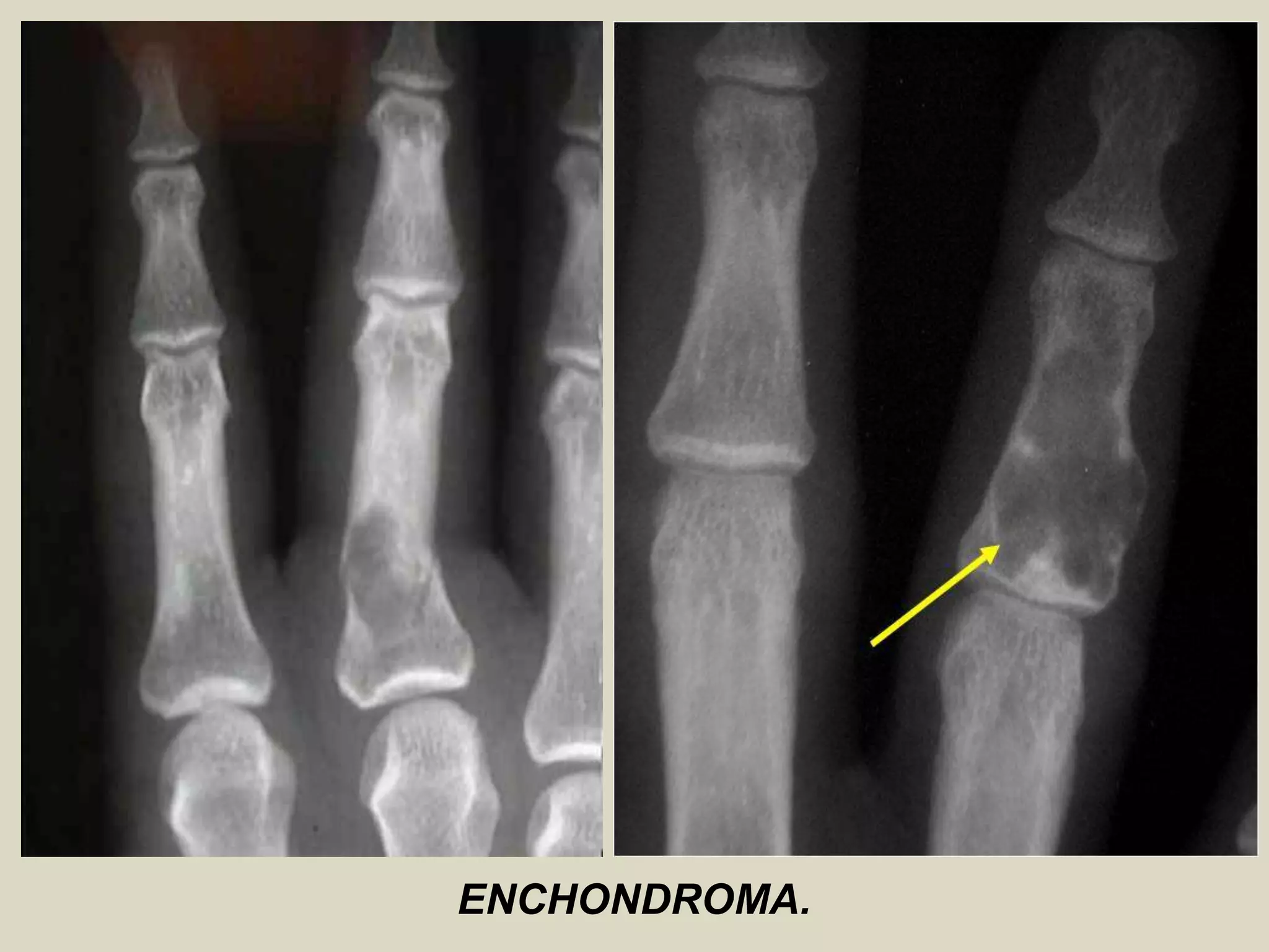 ENCHONDROMA.
 