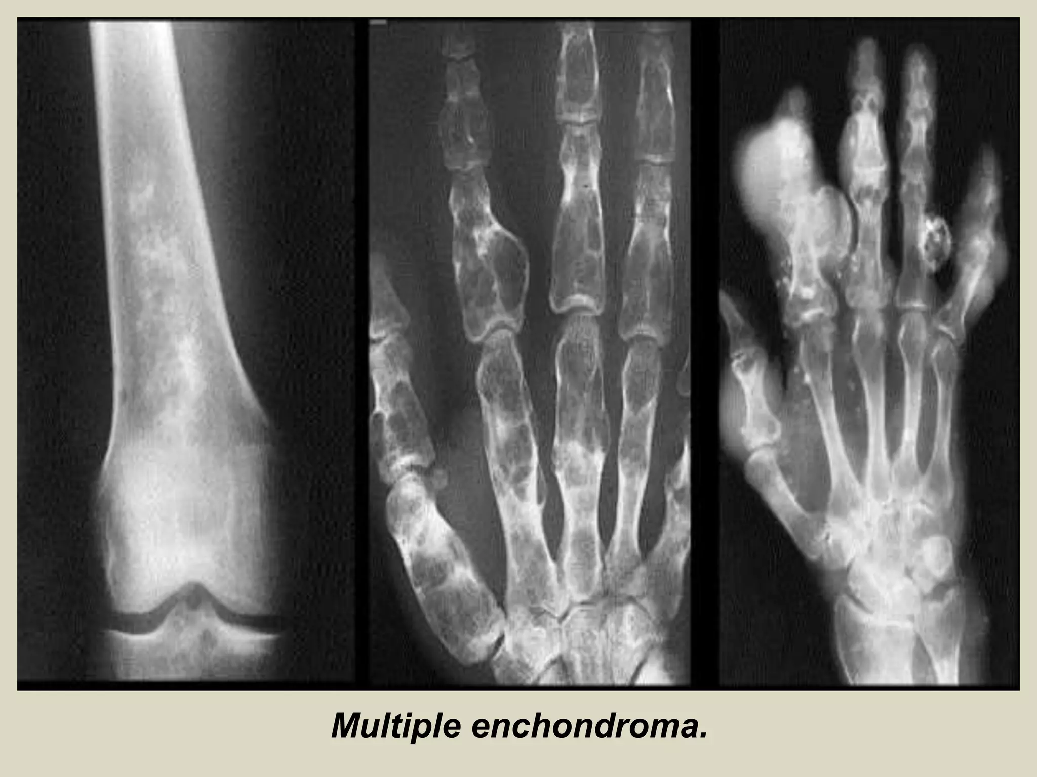 Multiple enchondroma.
 