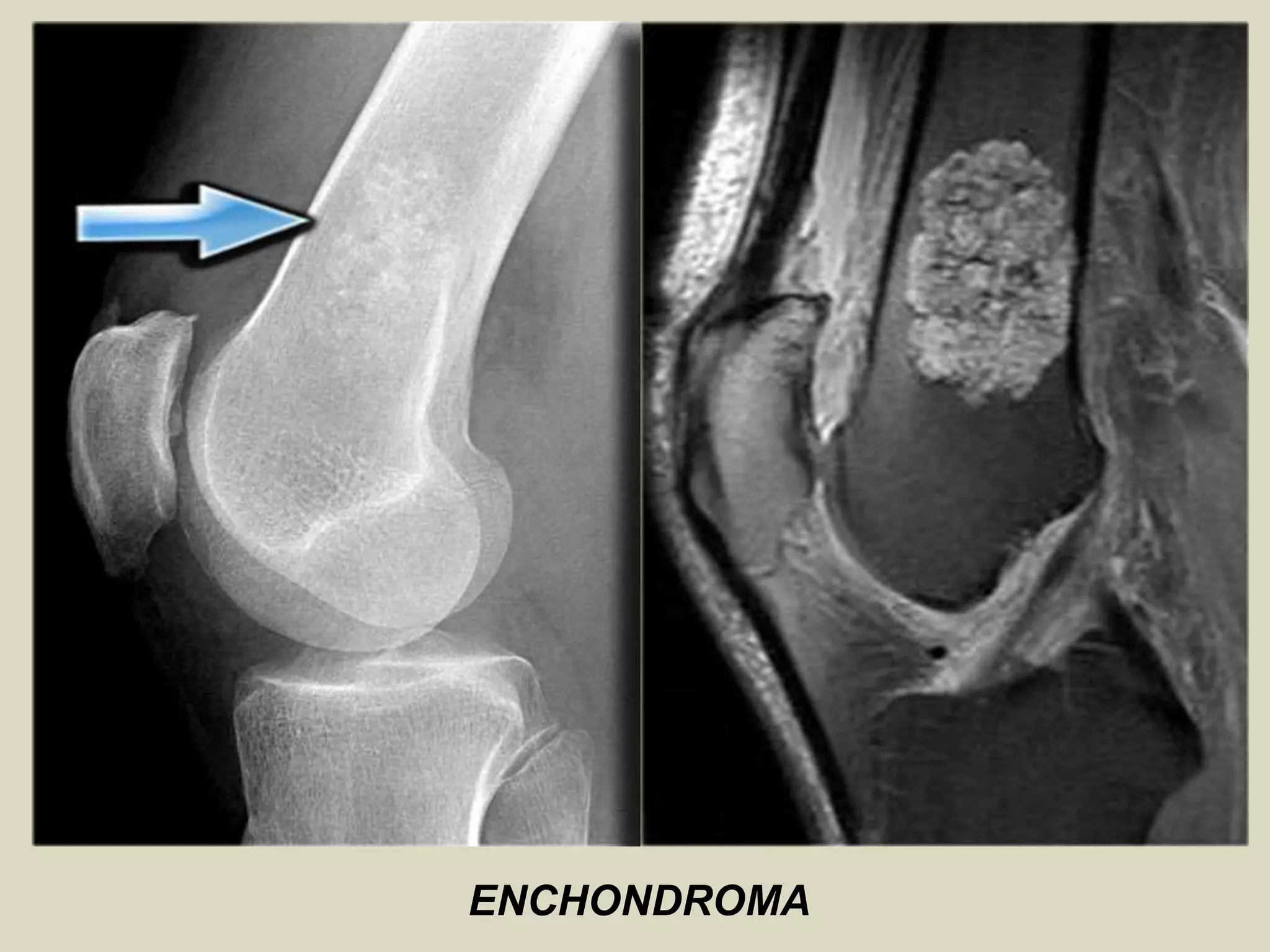 ENCHONDROMA
 