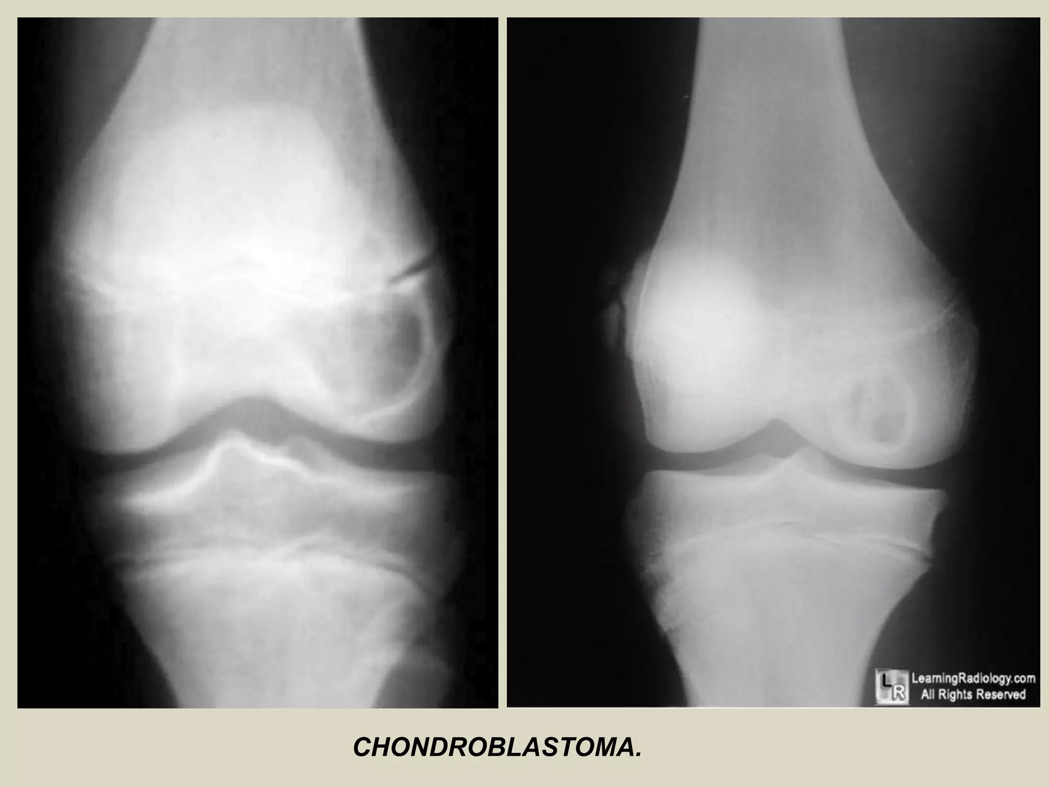 CHONDROBLASTOMA.
 
