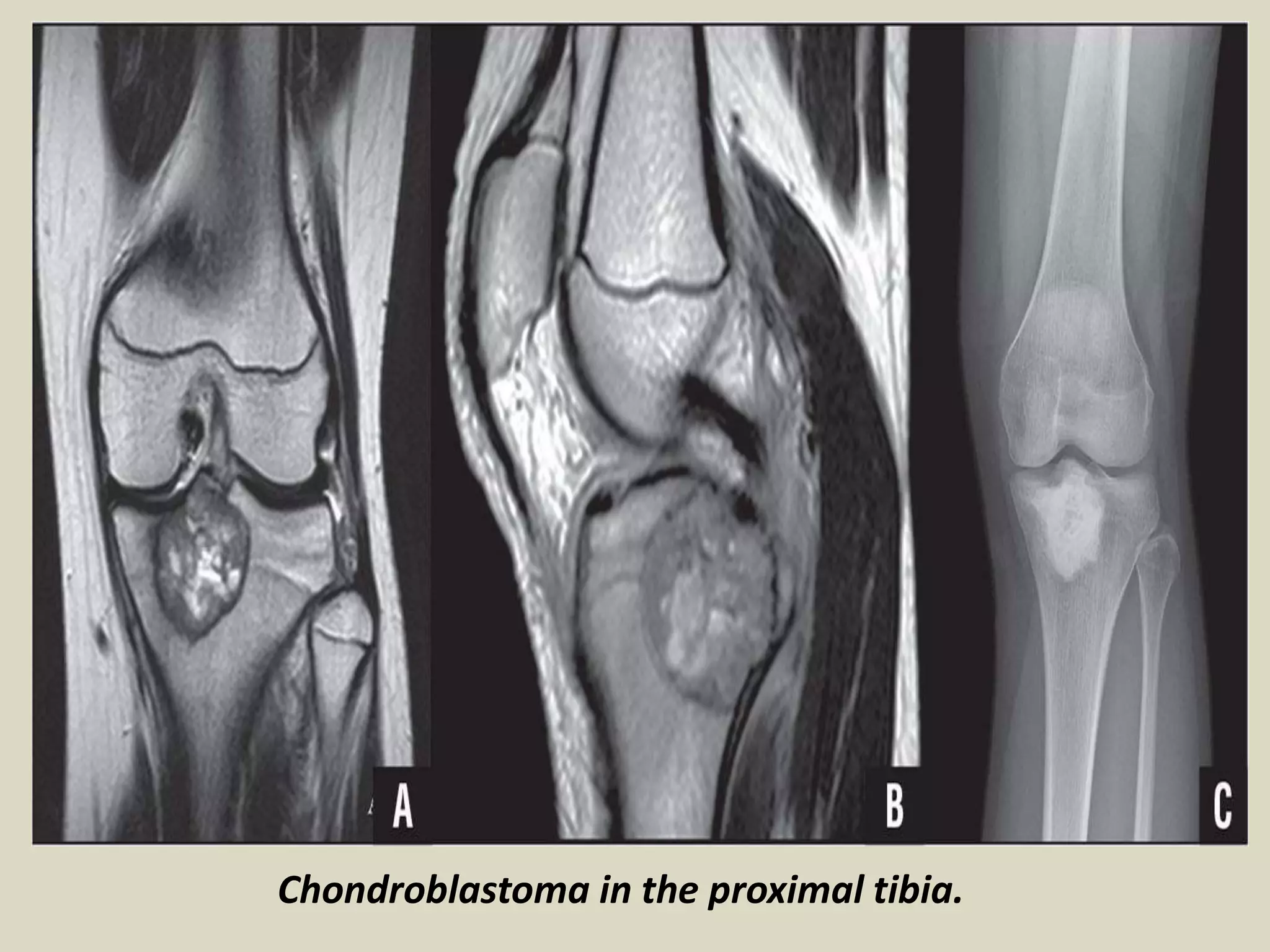 Chondroblastoma in the proximal tibia.
 