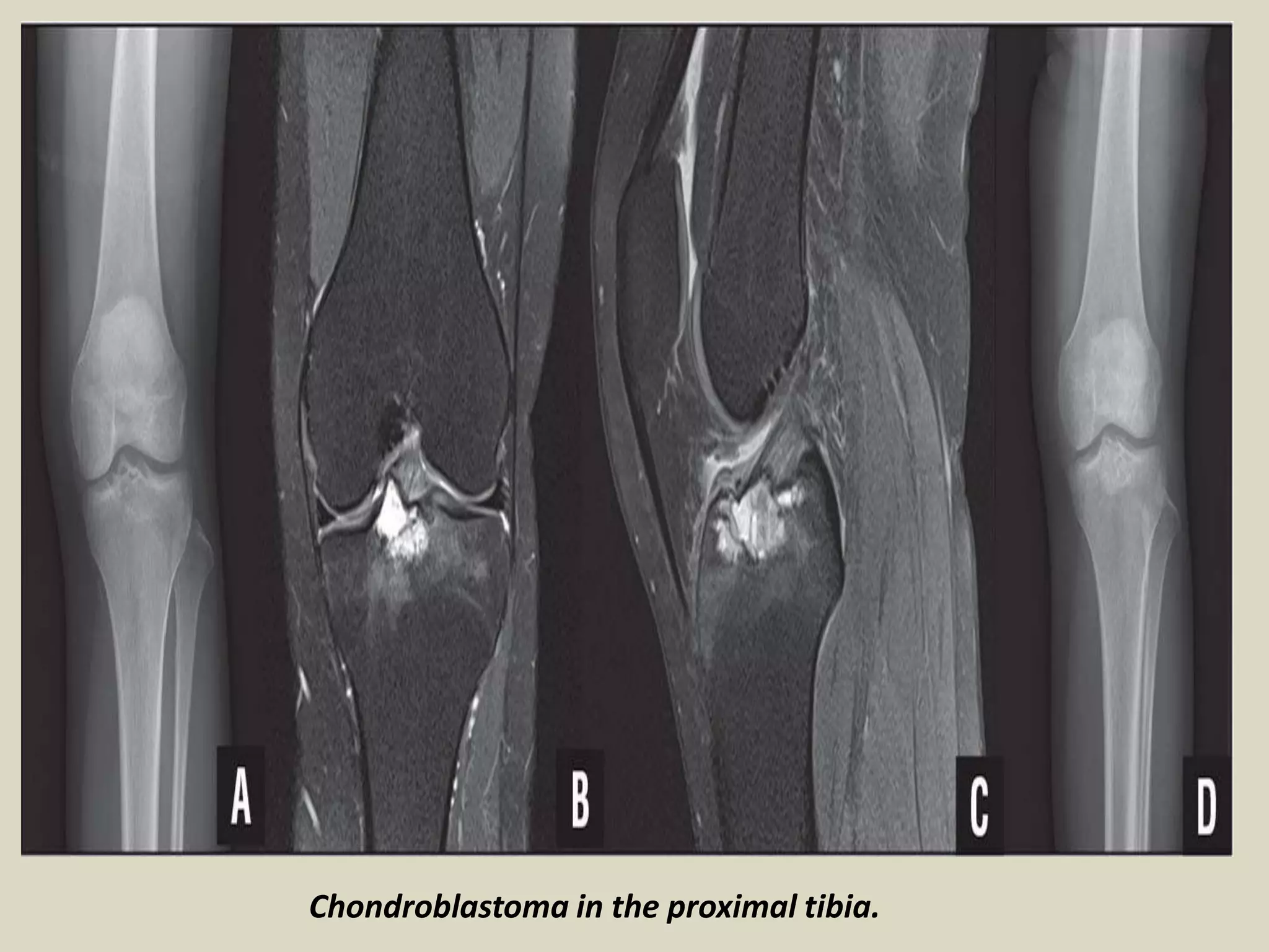 Chondroblastoma in the proximal tibia.
 