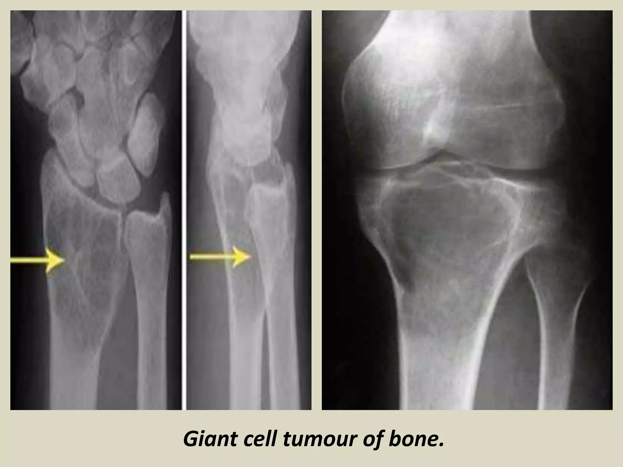Giant cell tumour of bone.
 