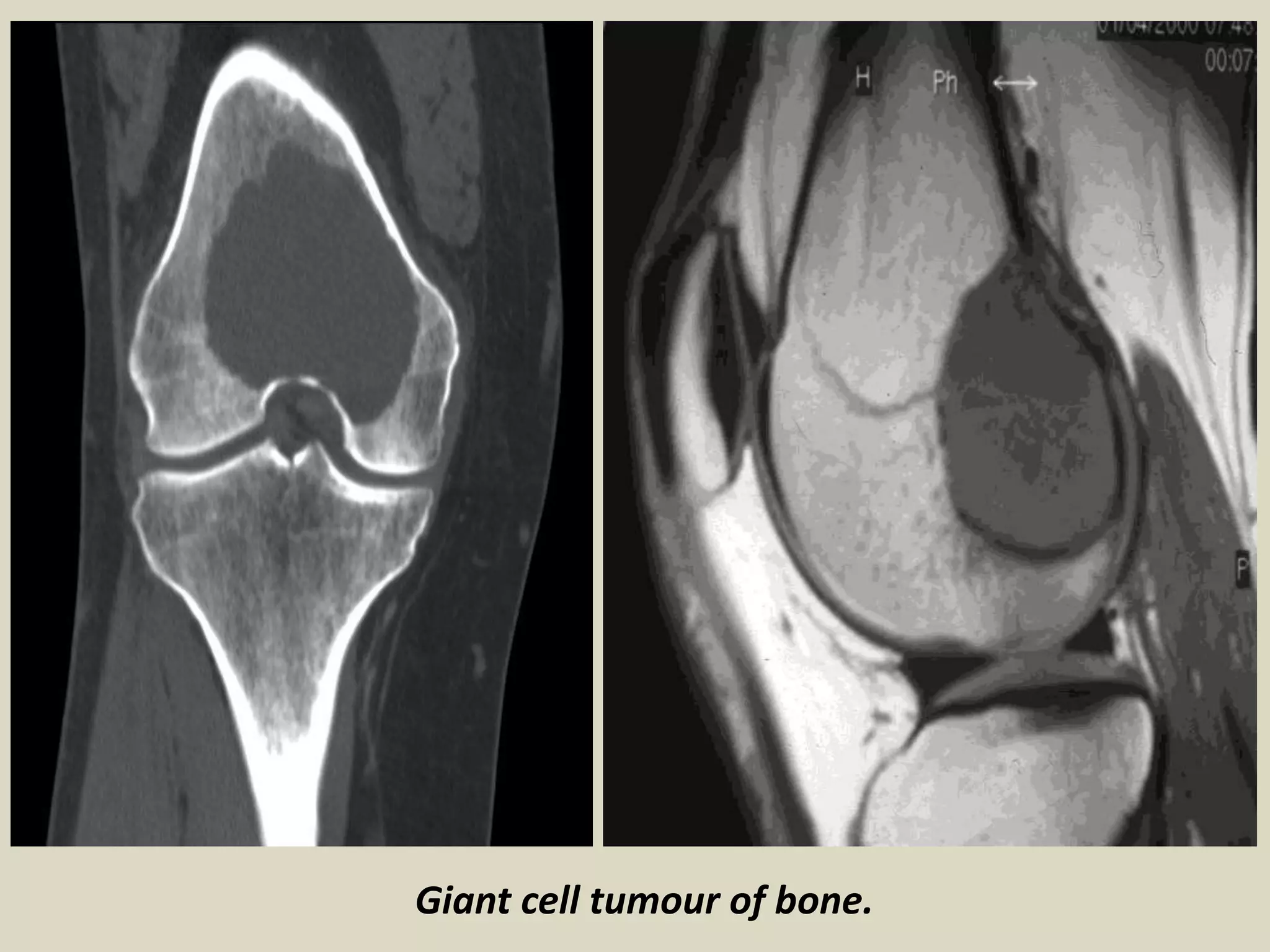 Giant cell tumour of bone.
 