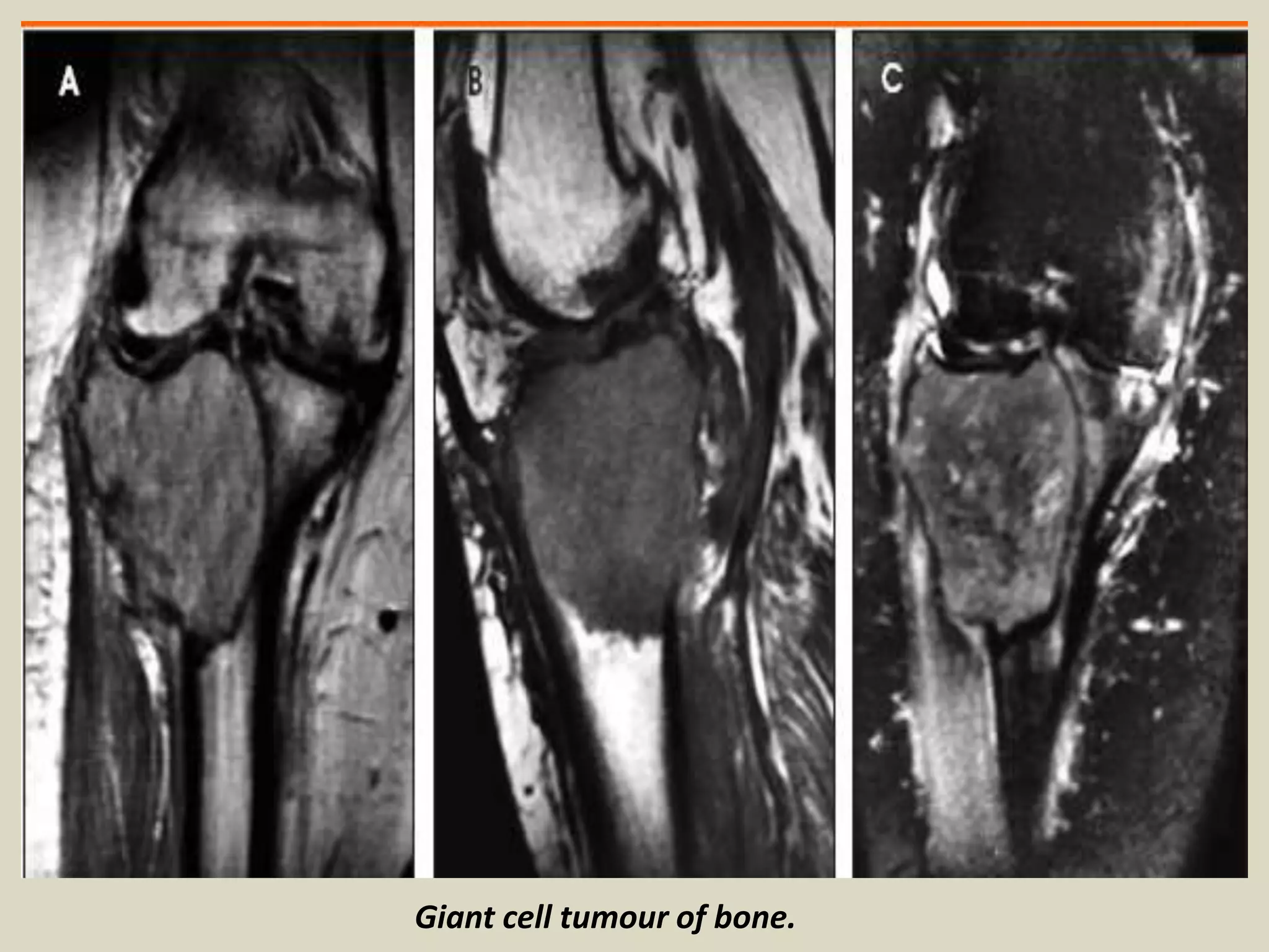 Giant cell tumour of bone.
 
