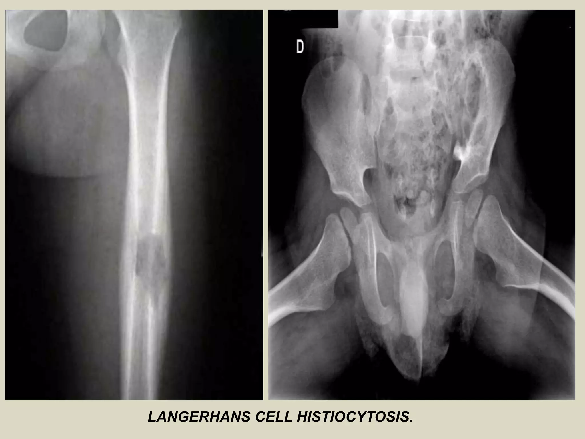 LANGERHANS CELL HISTIOCYTOSIS.
 