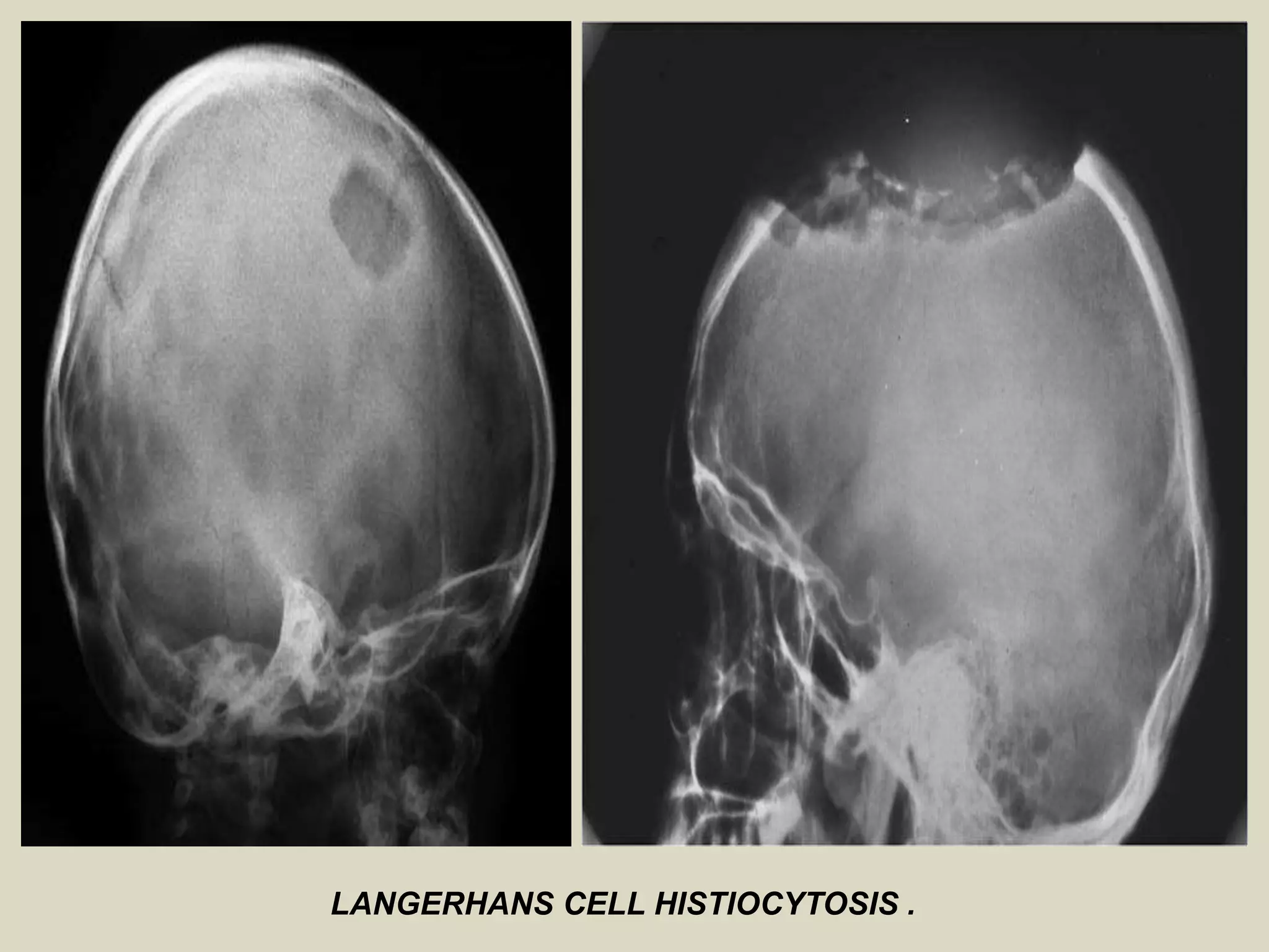 LANGERHANS CELL HISTIOCYTOSIS .
 
