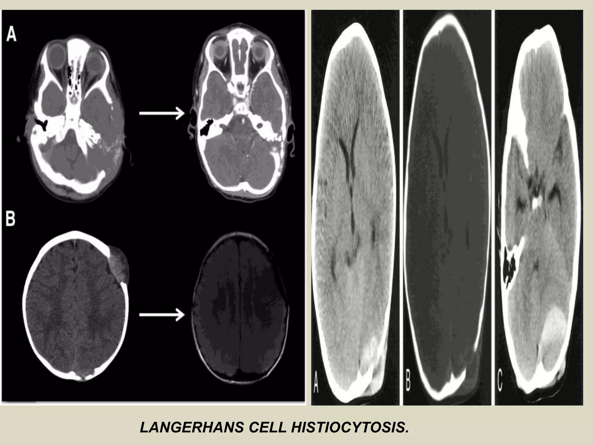LANGERHANS CELL HISTIOCYTOSIS.
 