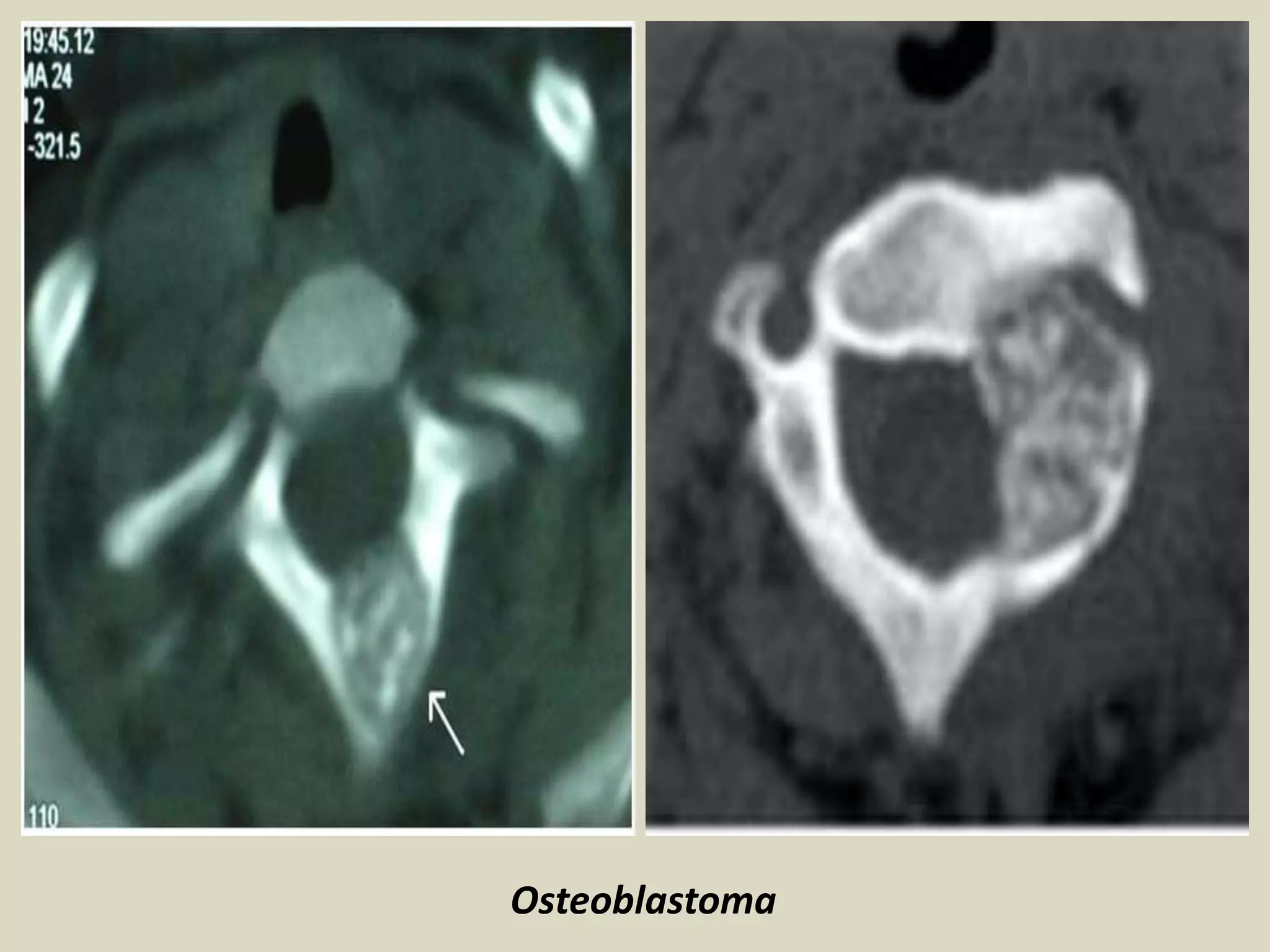 Osteoblastoma
 