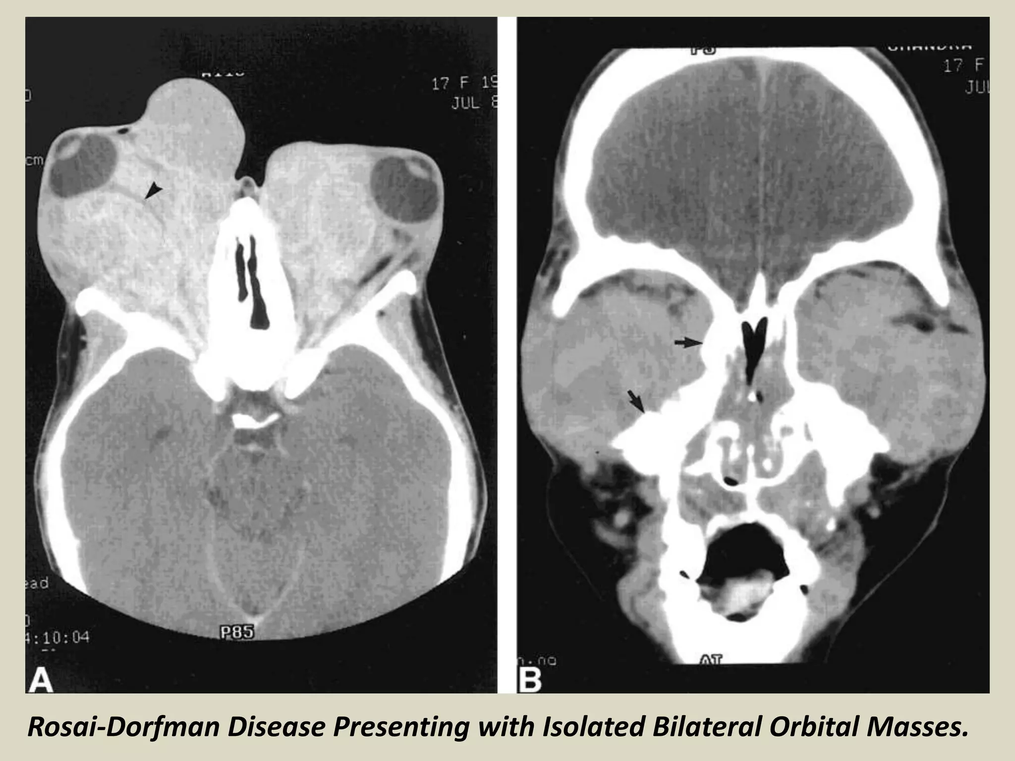 Rosai-Dorfman Disease Presenting with Isolated Bilateral Orbital Masses.
 
