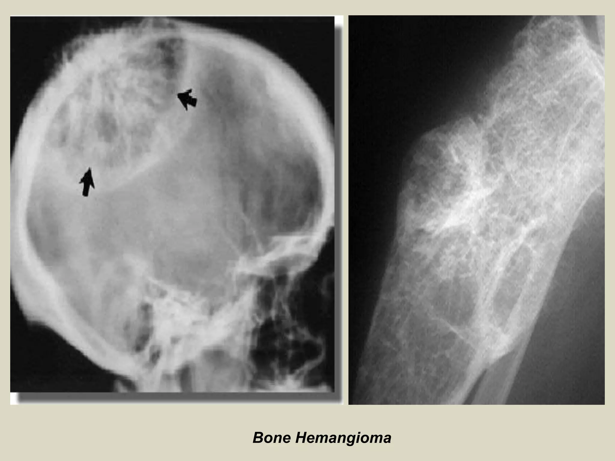 Bone Hemangioma
 