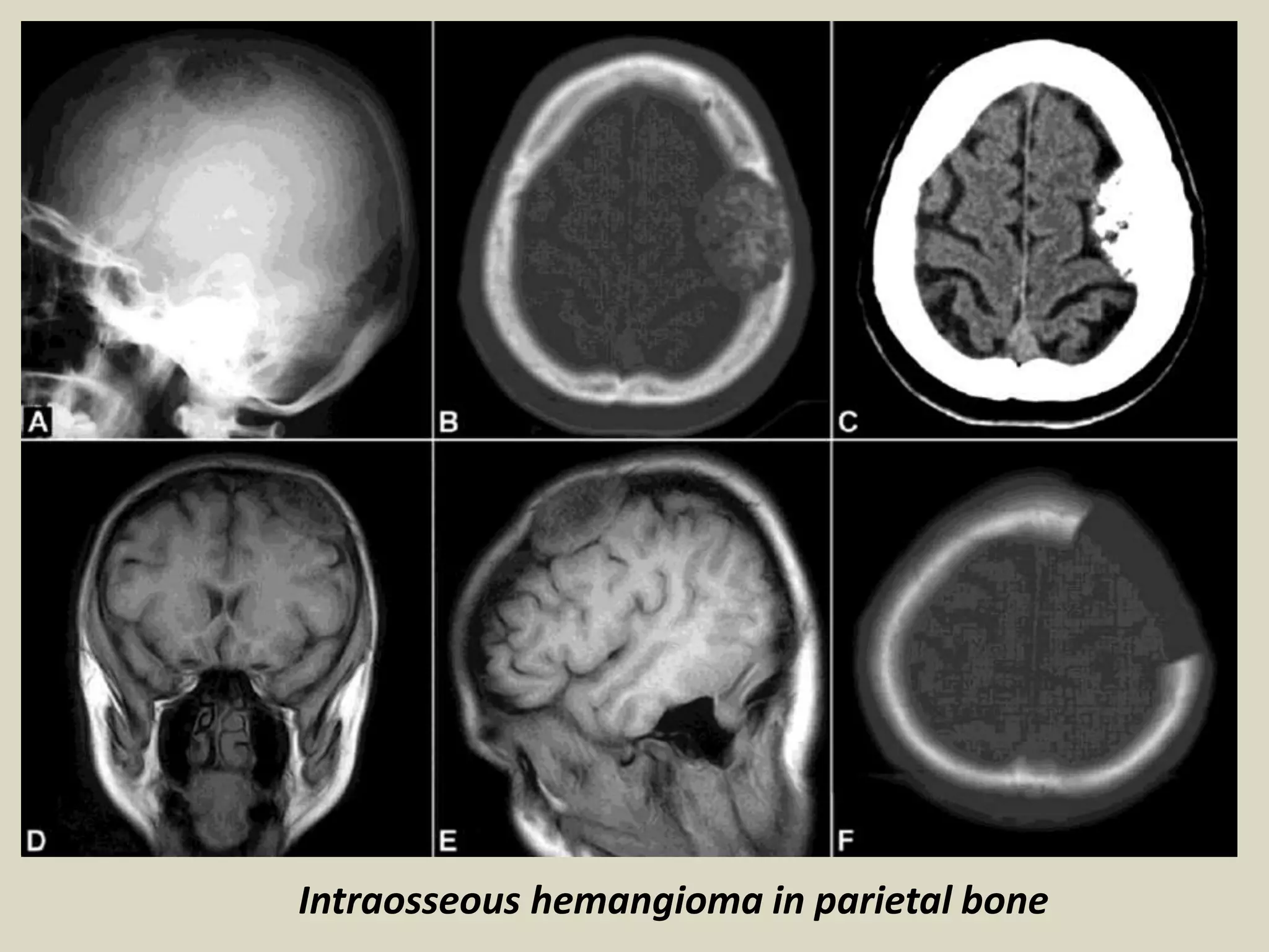 Intraosseous hemangioma in parietal bone
 