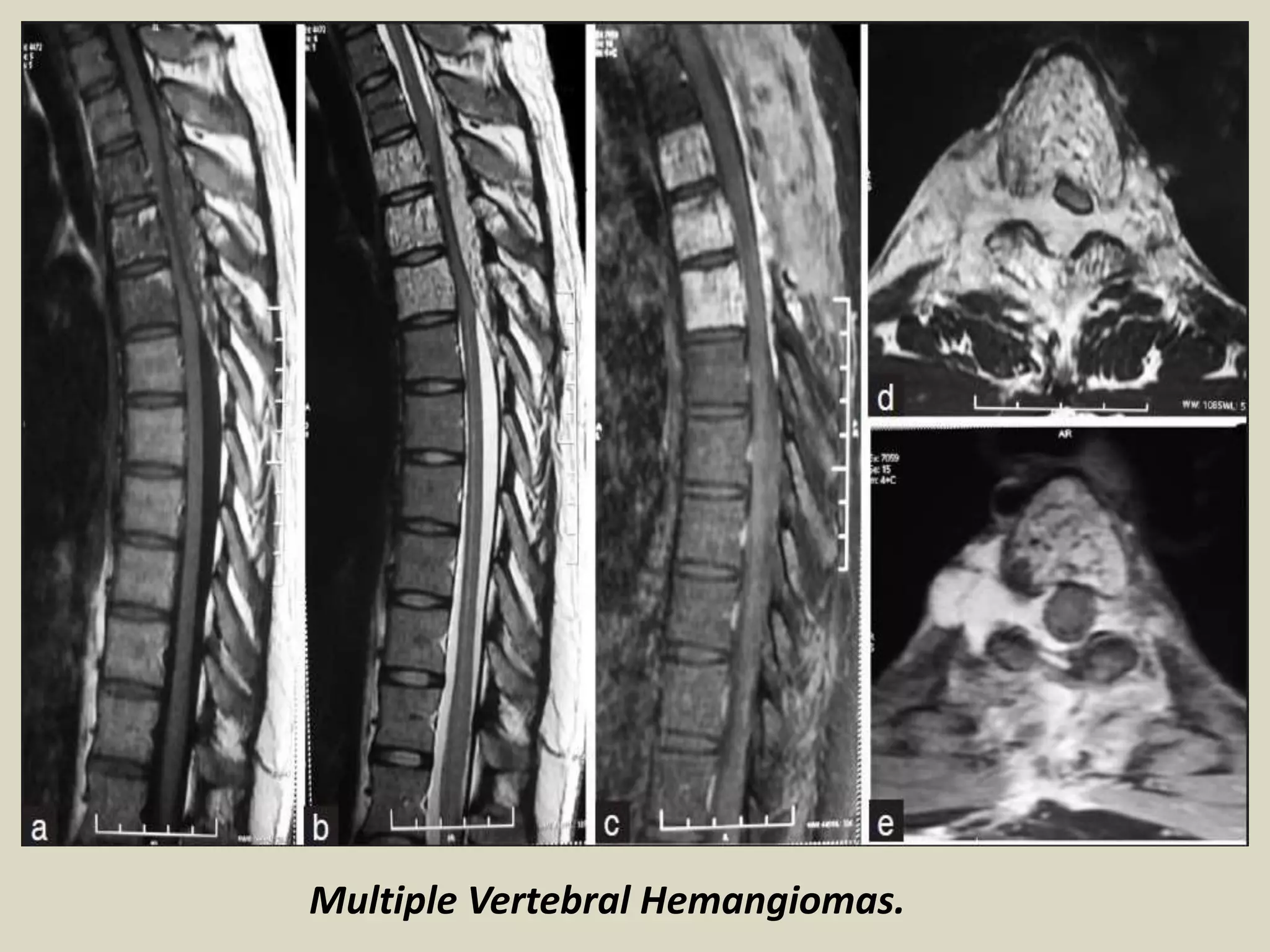Multiple Vertebral Hemangiomas.
 
