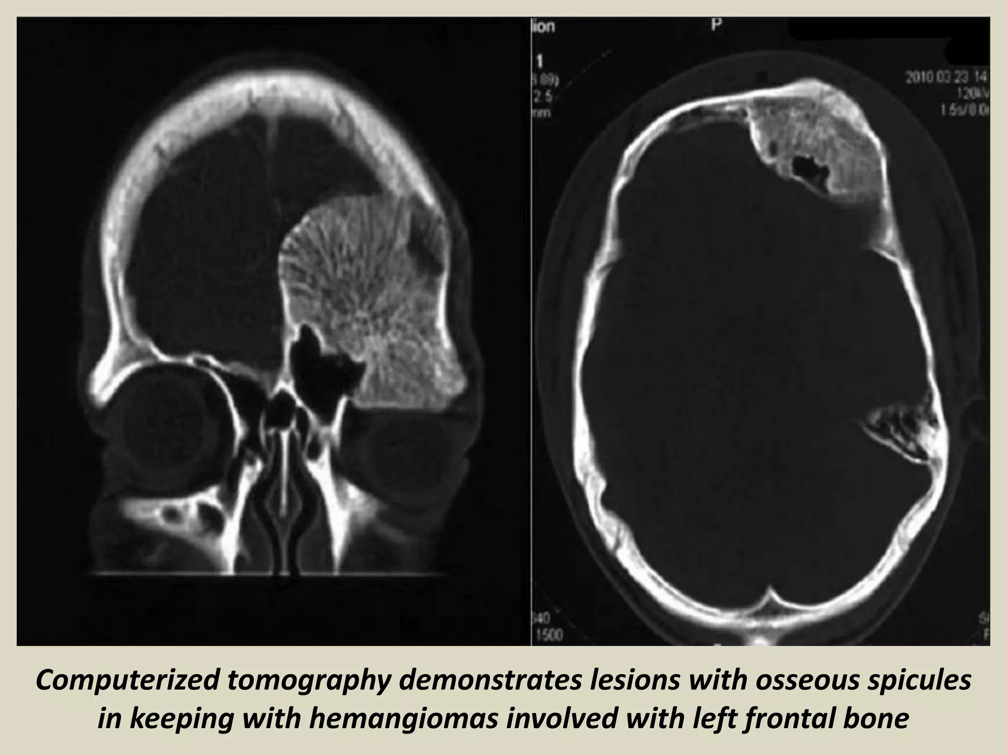 Computerized tomography demonstrates lesions with osseous spicules
in keeping with hemangiomas involved with left frontal bone
 