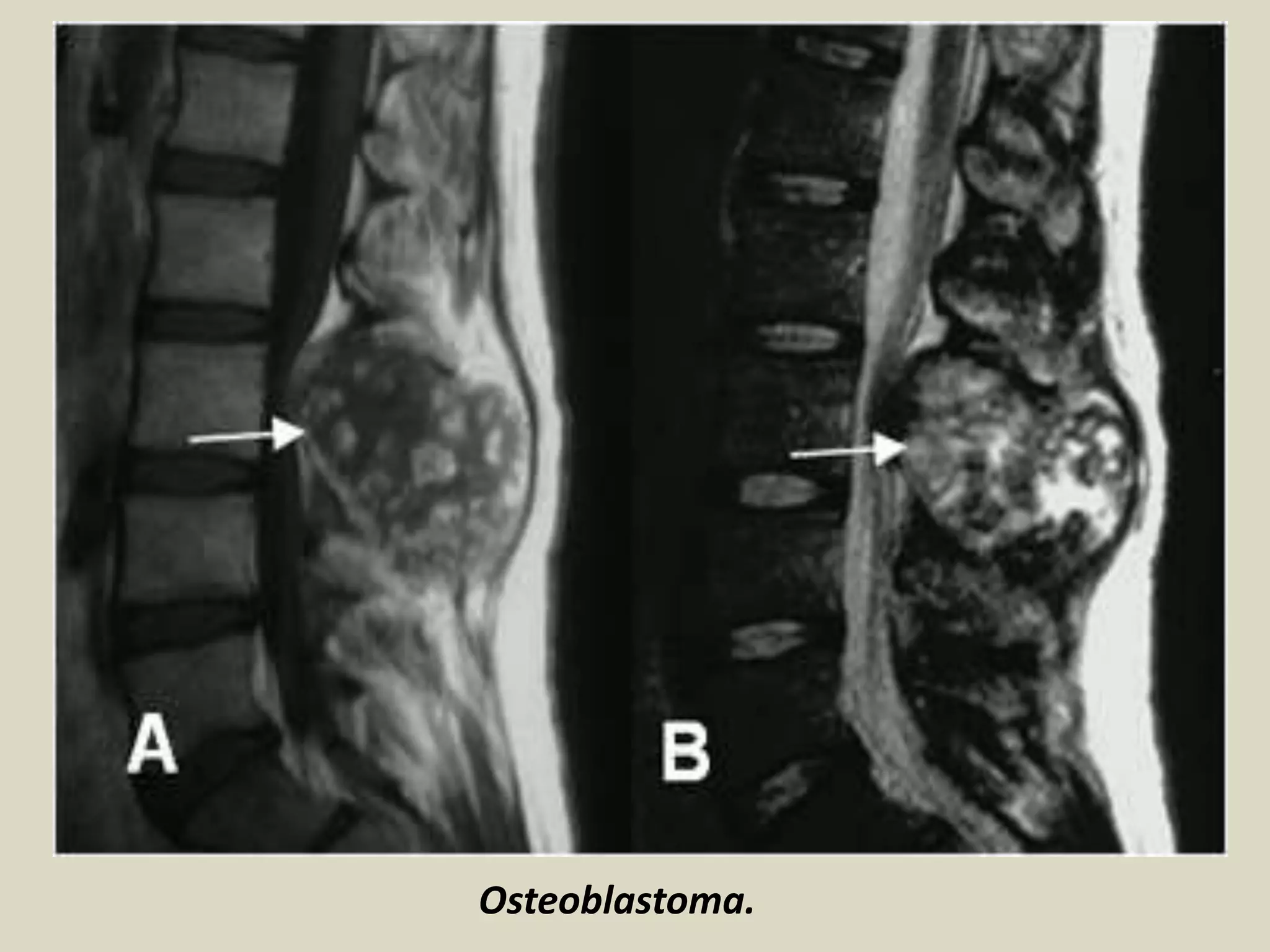 Osteoblastoma.
 