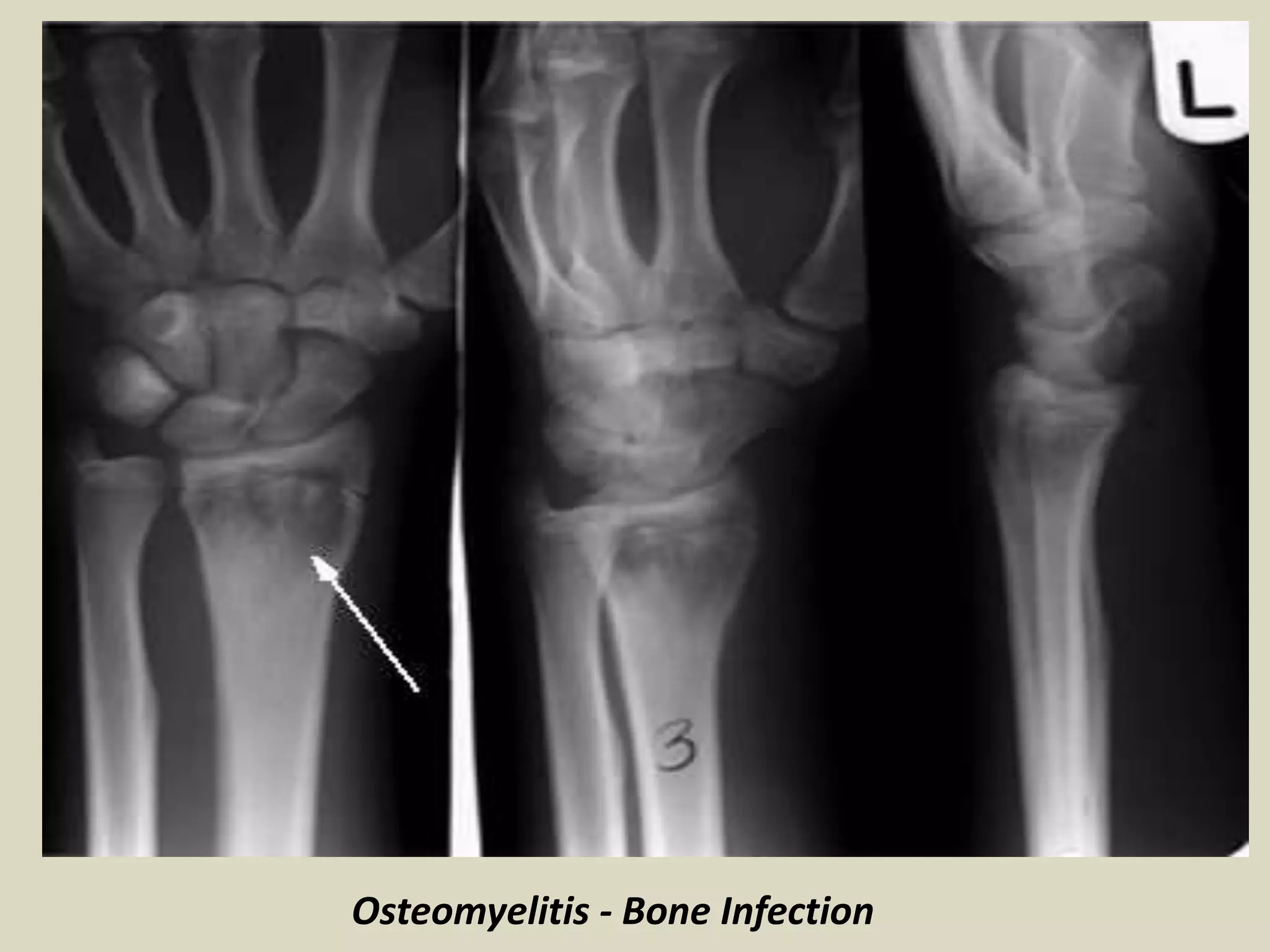 Osteomyelitis - Bone Infection
 