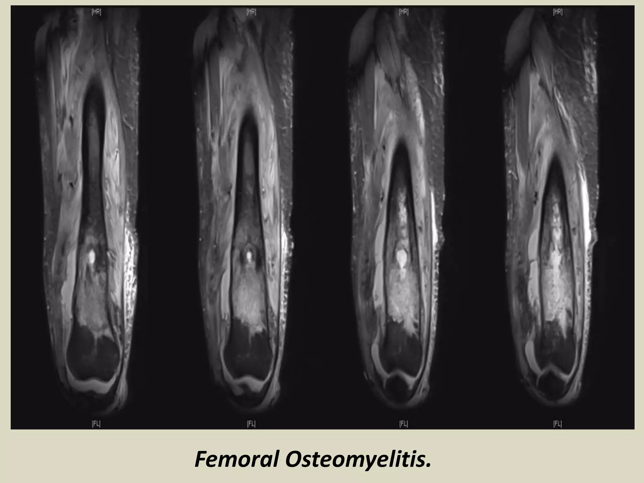Femoral Osteomyelitis.
 