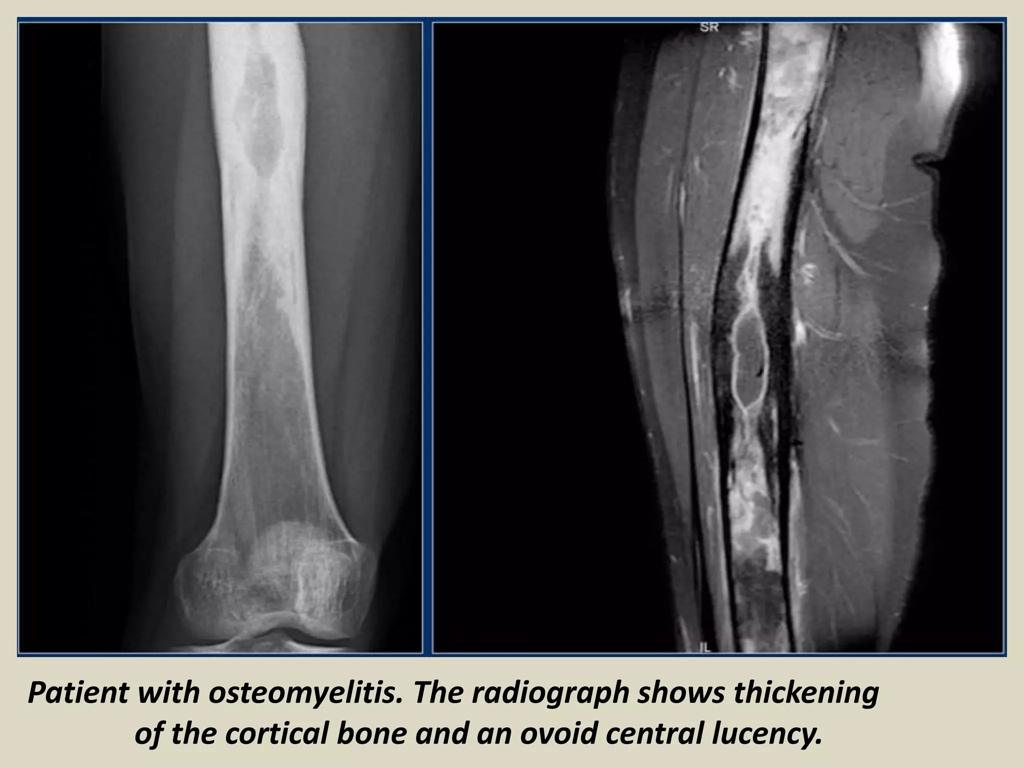 Patient with osteomyelitis. The radiograph shows thickening
of the cortical bone and an ovoid central lucency.
 