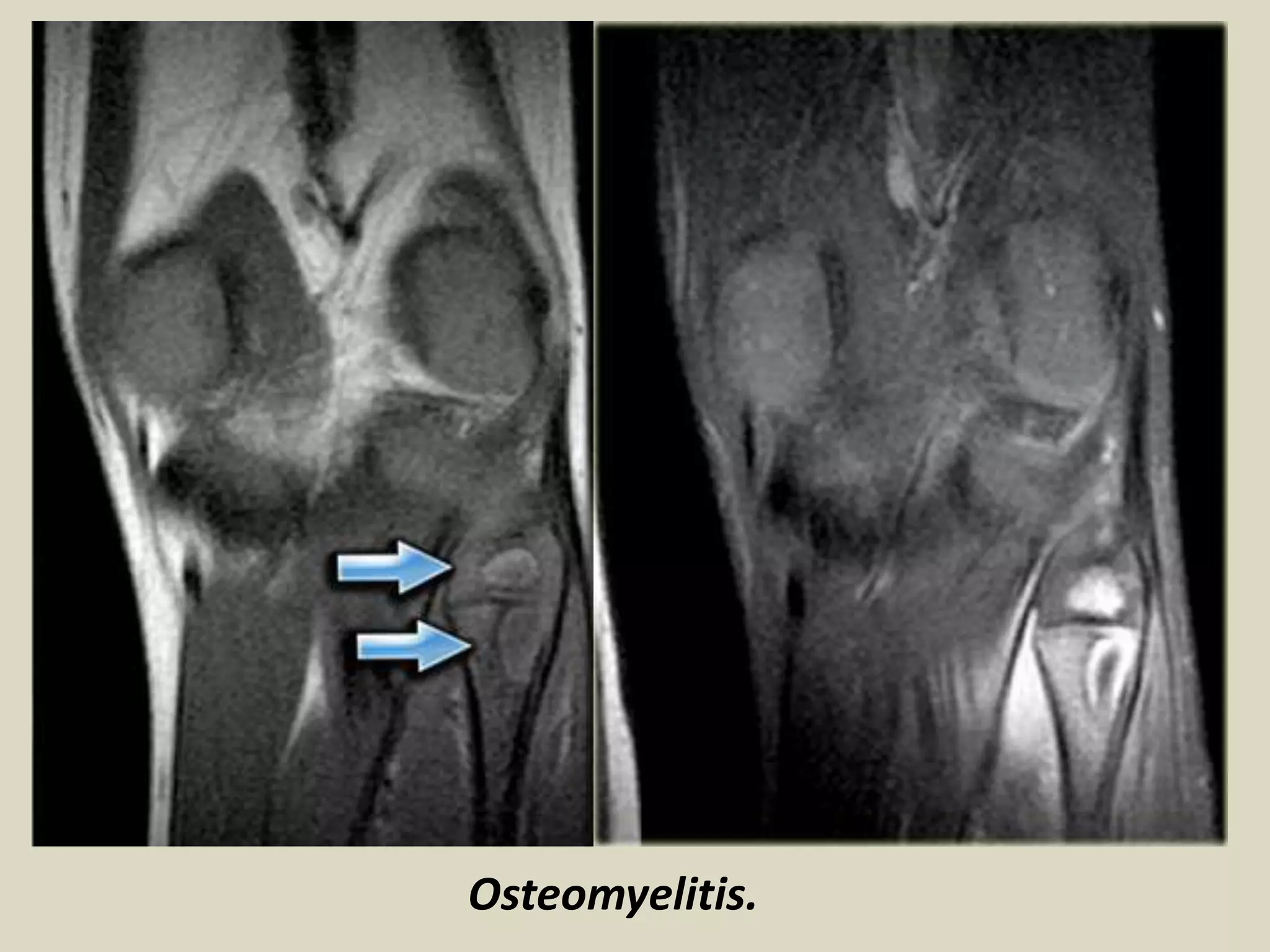 Osteomyelitis.
 