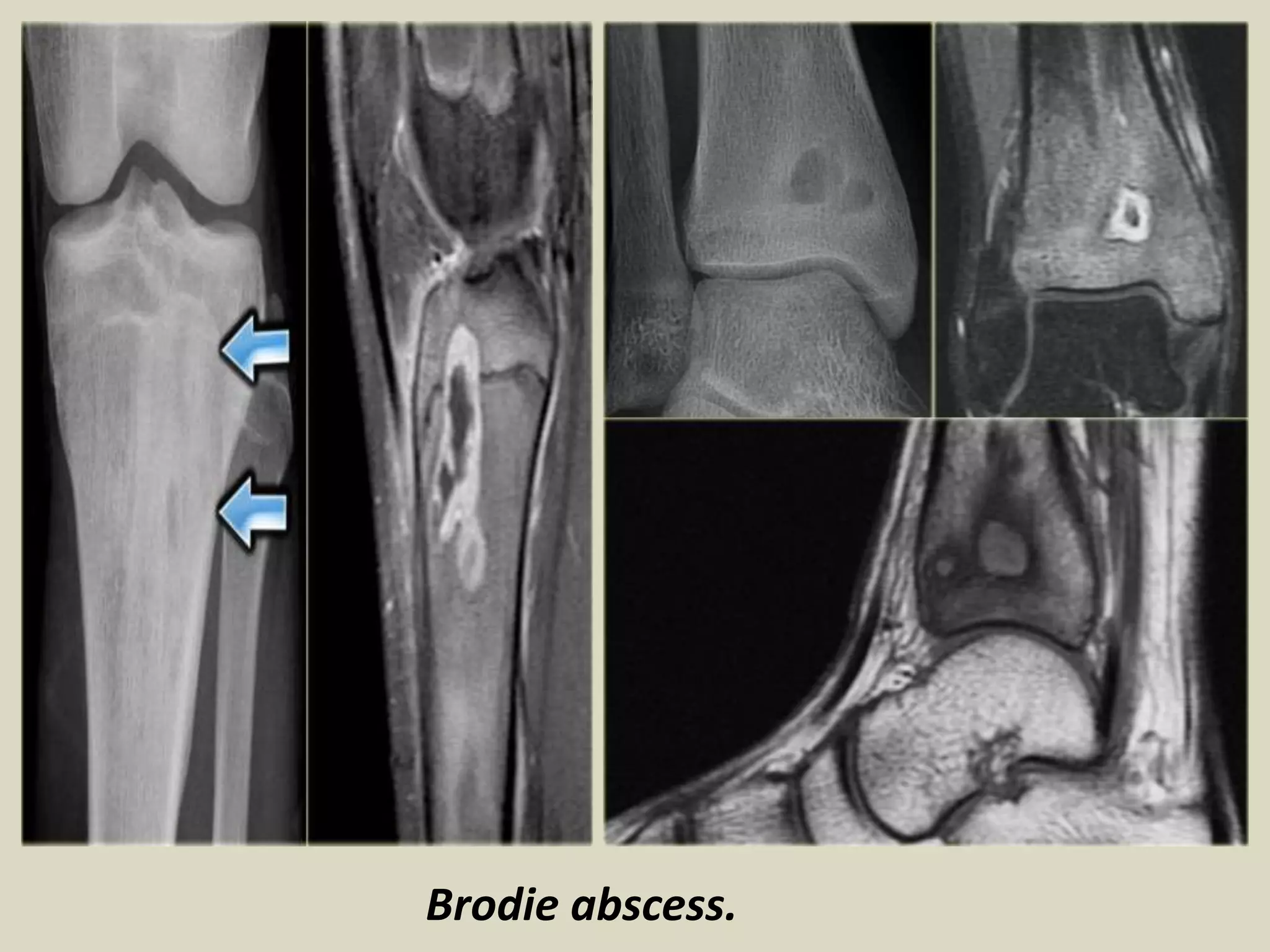 Brodie abscess.
 