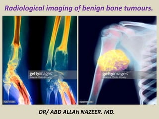 DR/ ABD ALLAH NAZEER. MD.
Radiological imaging of benign bone tumours.
 