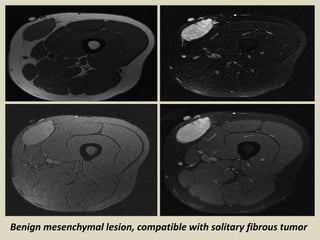 Presentation1.pptx radio;ogical imaging of benign and malignant soft ...